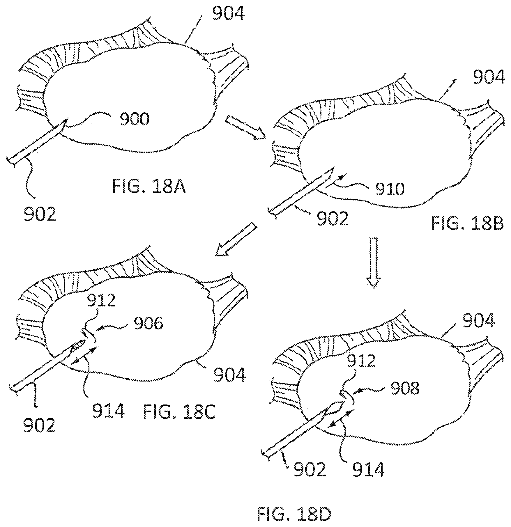 Patent US11793564 Figure 13 – Methods and systems for the treatment of polycystic ovary syndrome