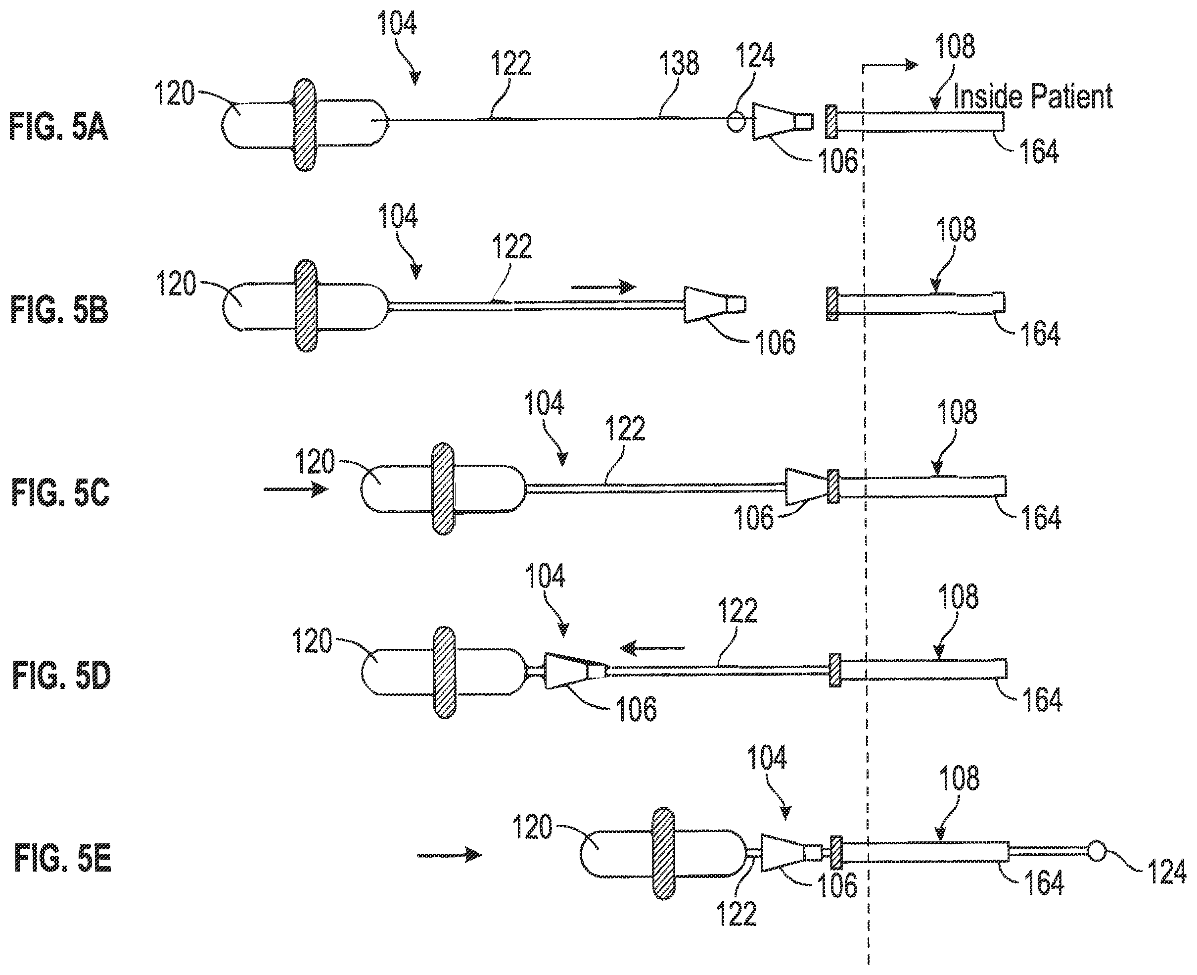Patent US11793567 Figure 4 – Catheter insertion