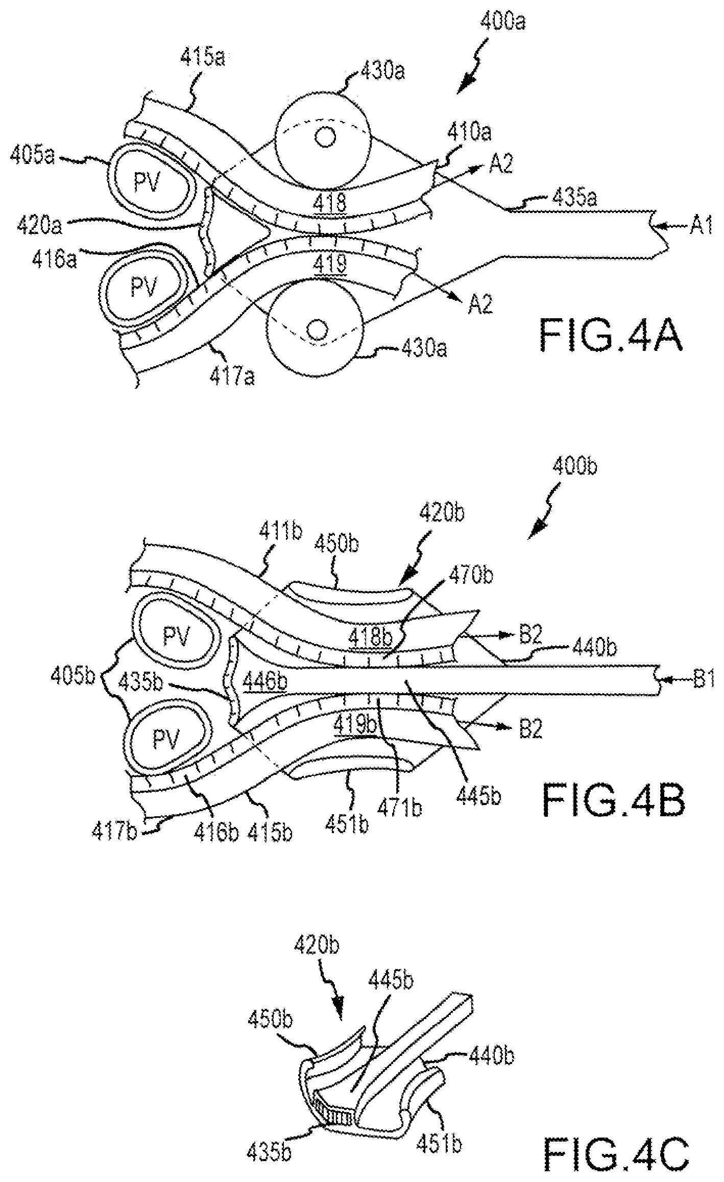 Patent US11793568 Figure 2 – Bipolar belt systems and methods
