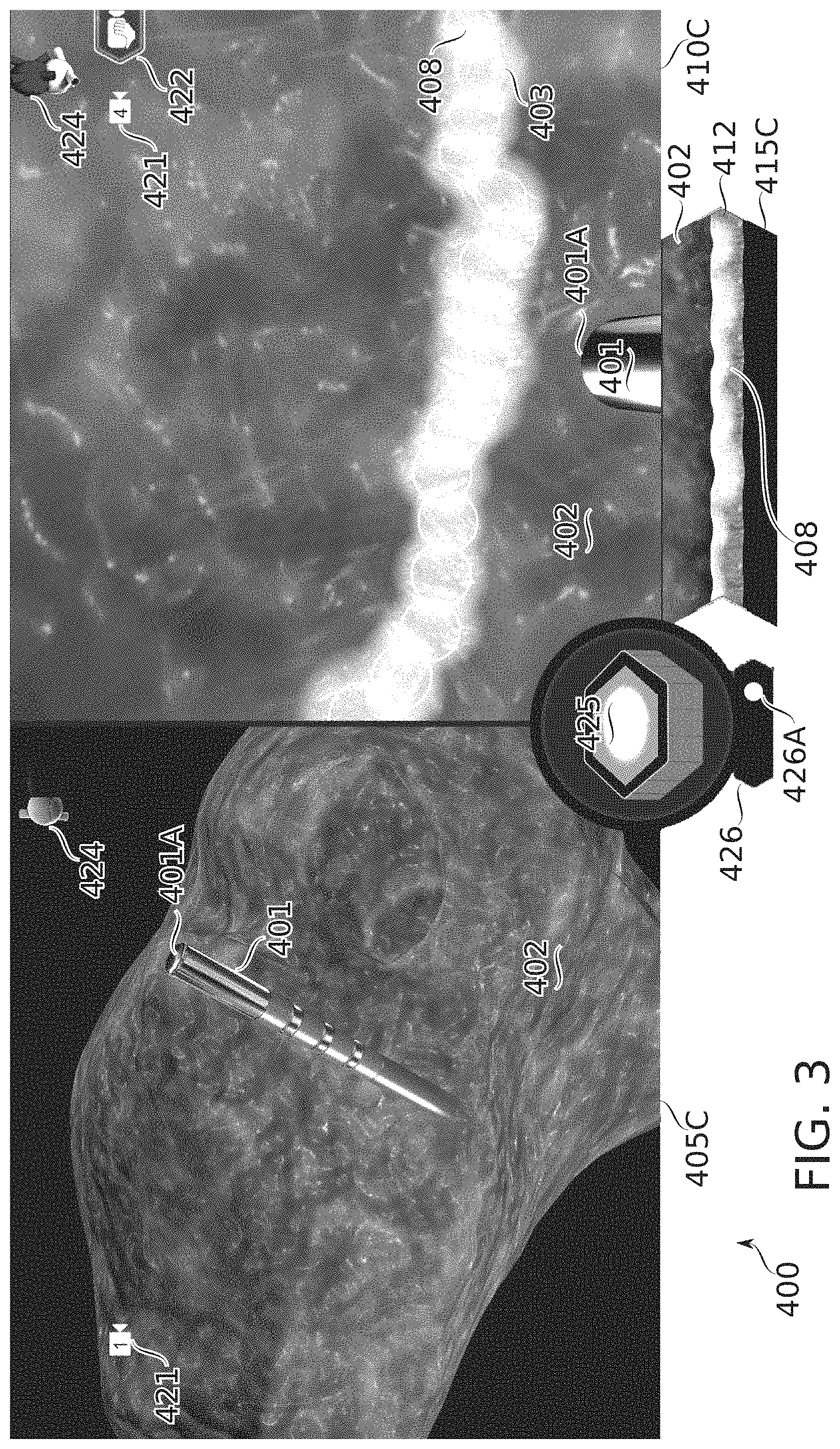 Patent US11793571 Figure 4 – Real-time display of treatment-related tissue changes using virtual material