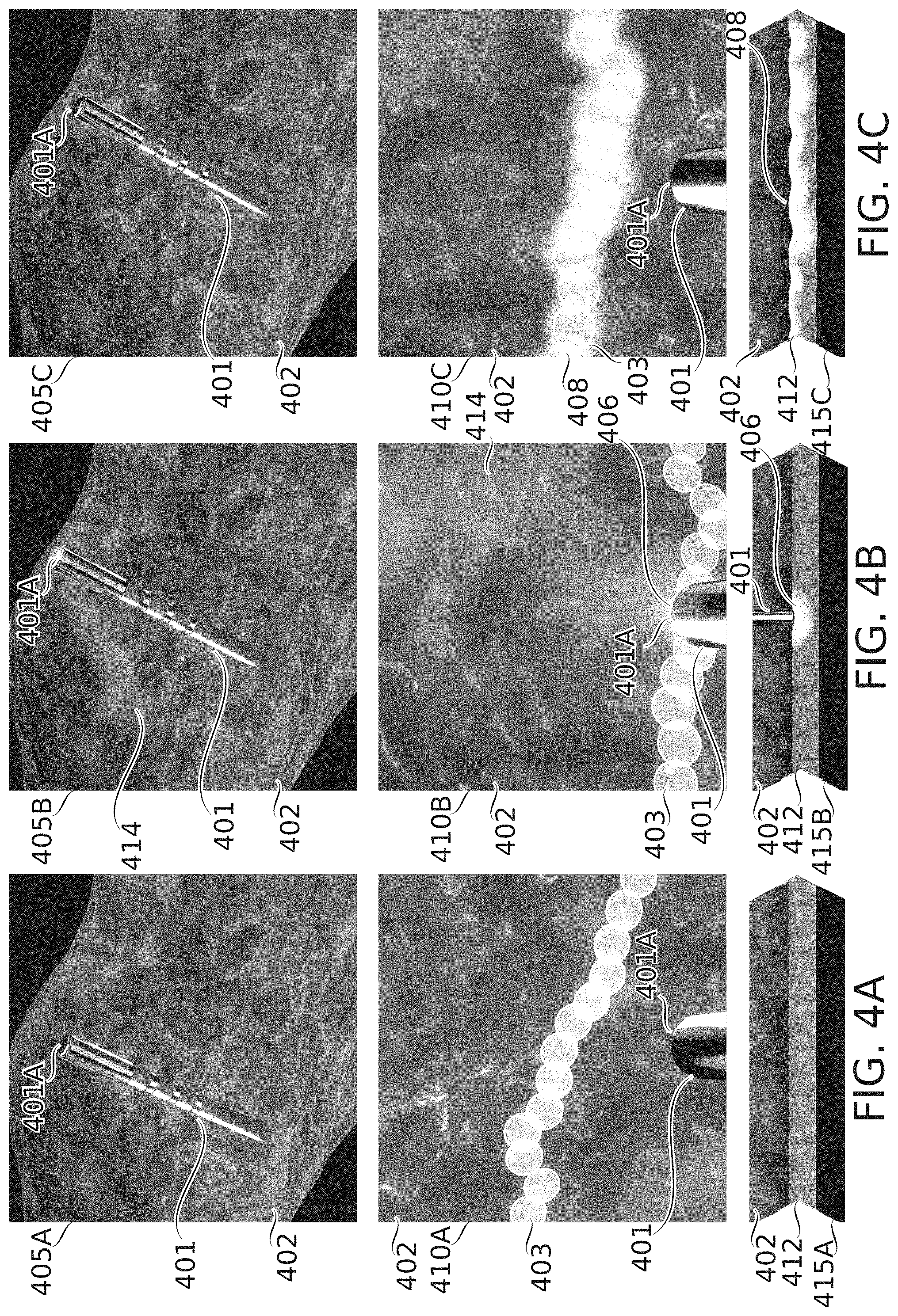 Patent US11793571 Figure 5 – Real-time display of treatment-related tissue changes using virtual material