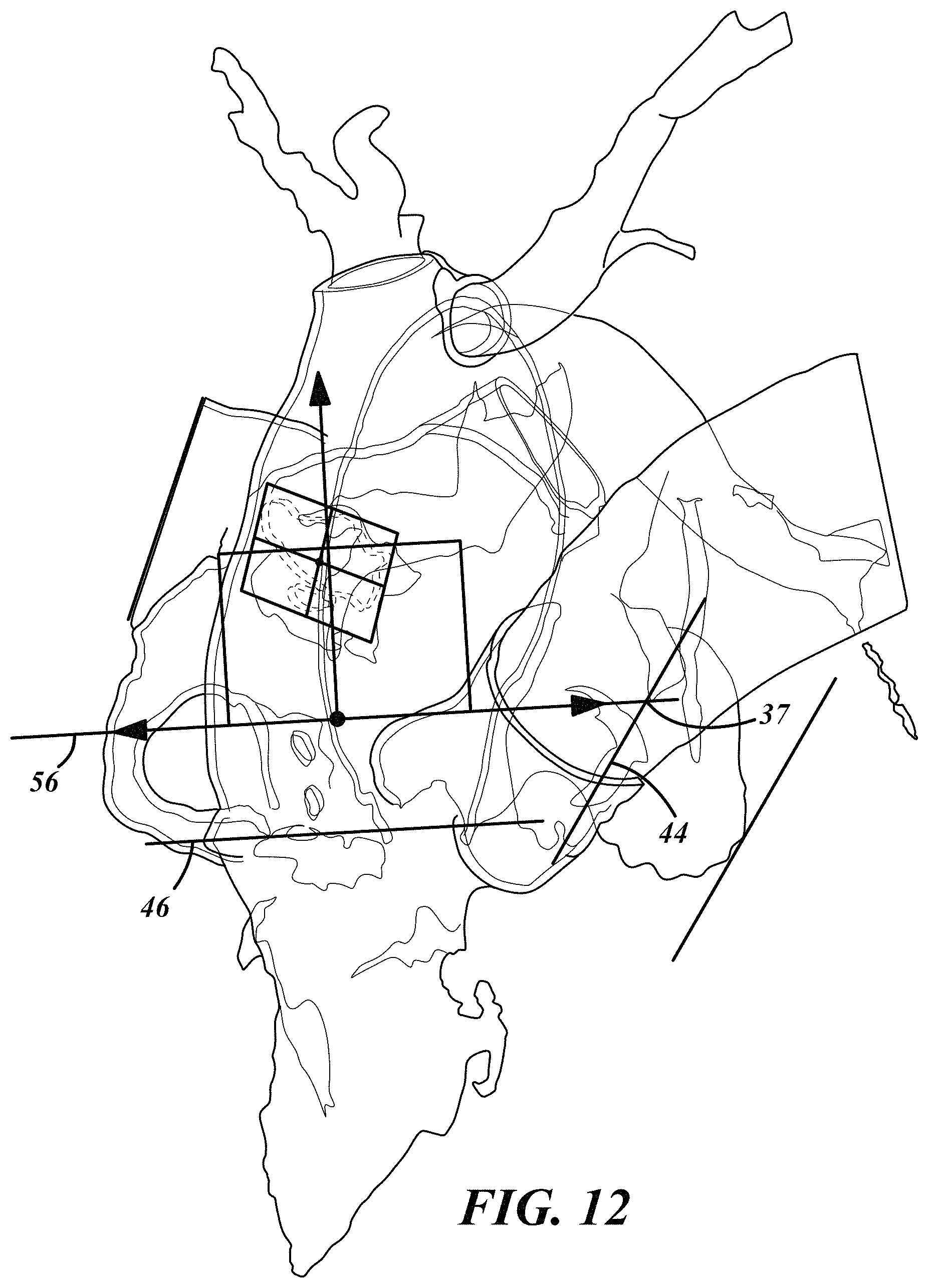 Patent US11793572 Figure 12 – Selecting a medical device for use in a medical procedure