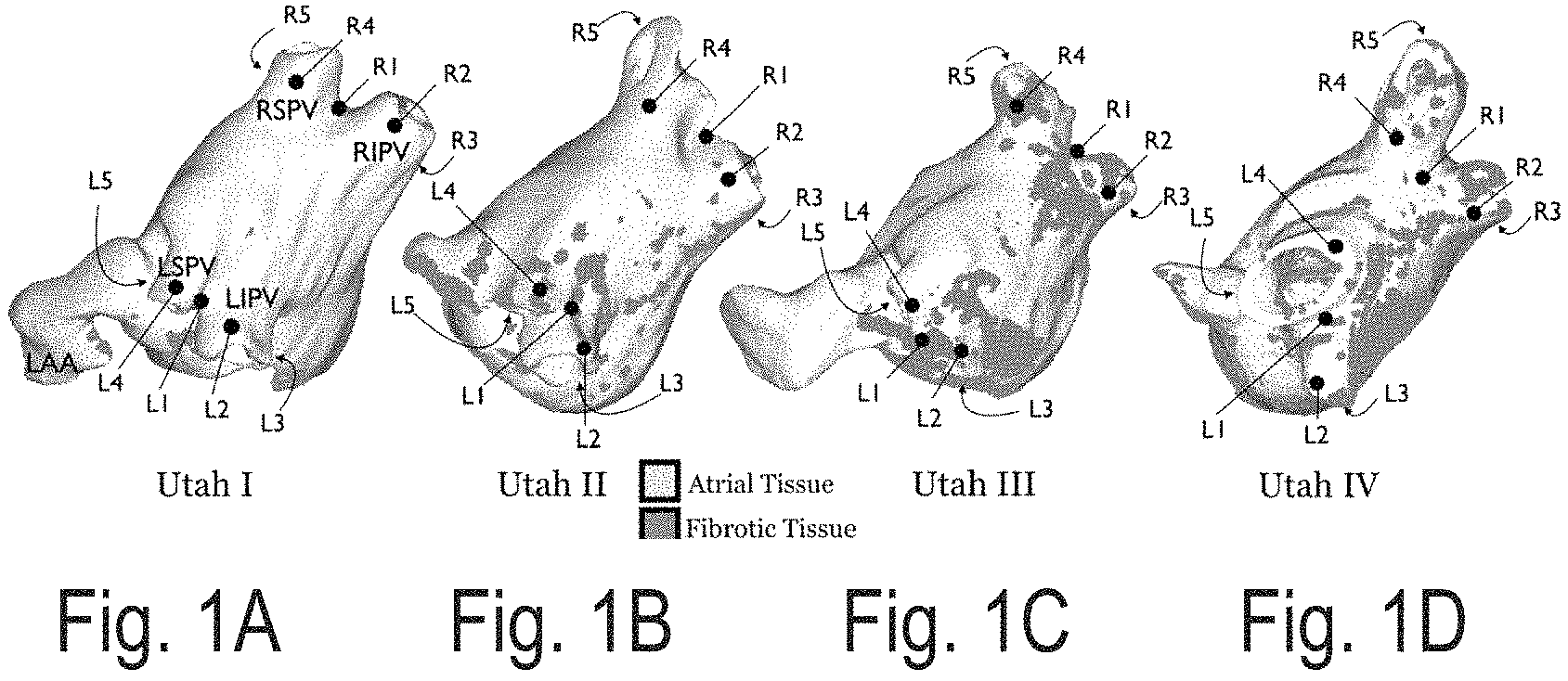 Patent US11793573 Figure 1 – Personalized computation modeling of atrial fibrosis to guide catheter ablation of atrial fibrillation