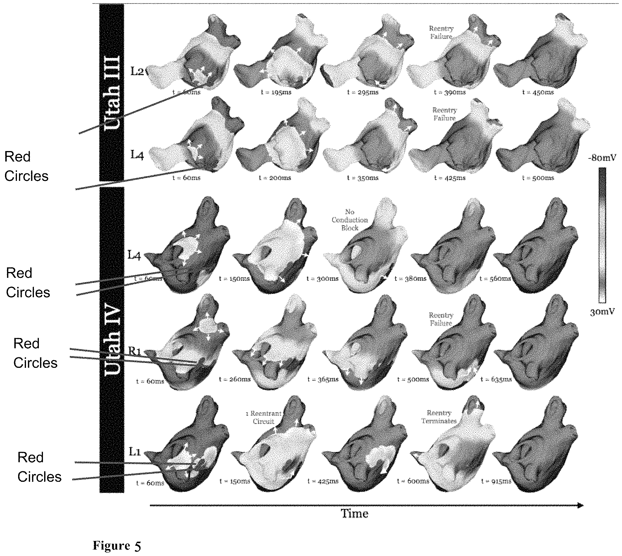 Patent US11793573 Figure 5 – Personalized computation modeling of atrial fibrosis to guide catheter ablation of atrial fibrillation