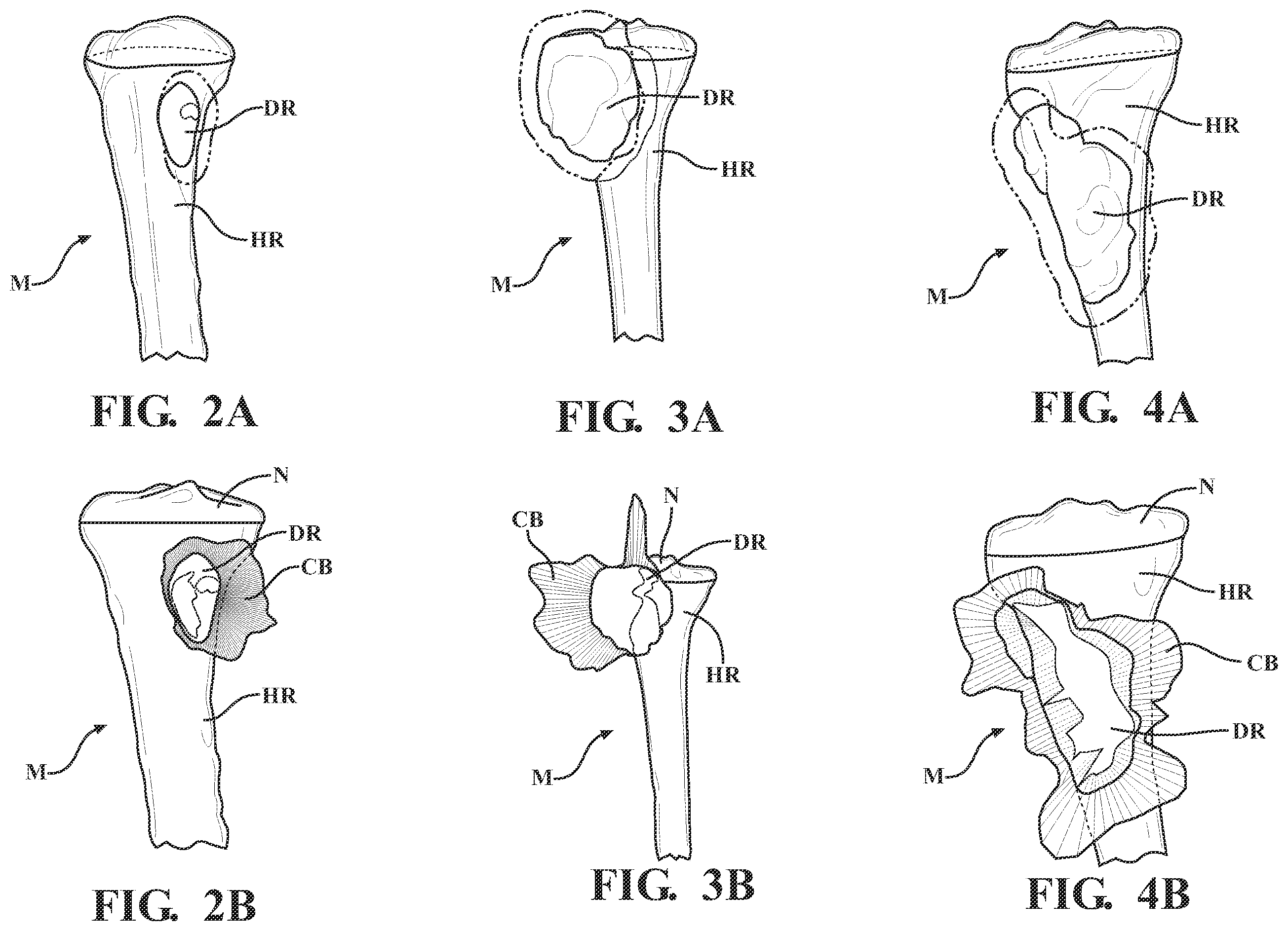 Patent US11793574 Figure 2 – Automated cut planning for removal of diseased regions