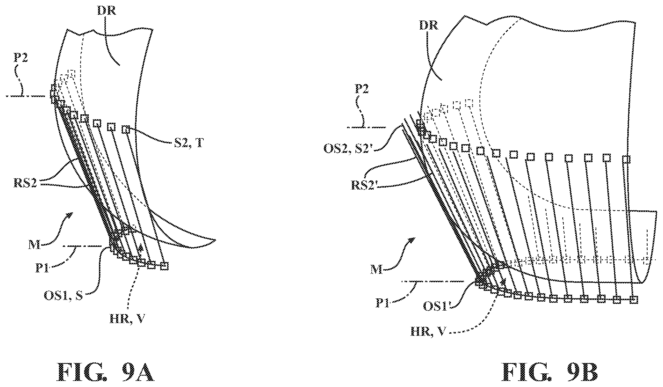 Patent US11793574 Figure 6 – Automated cut planning for removal of diseased regions