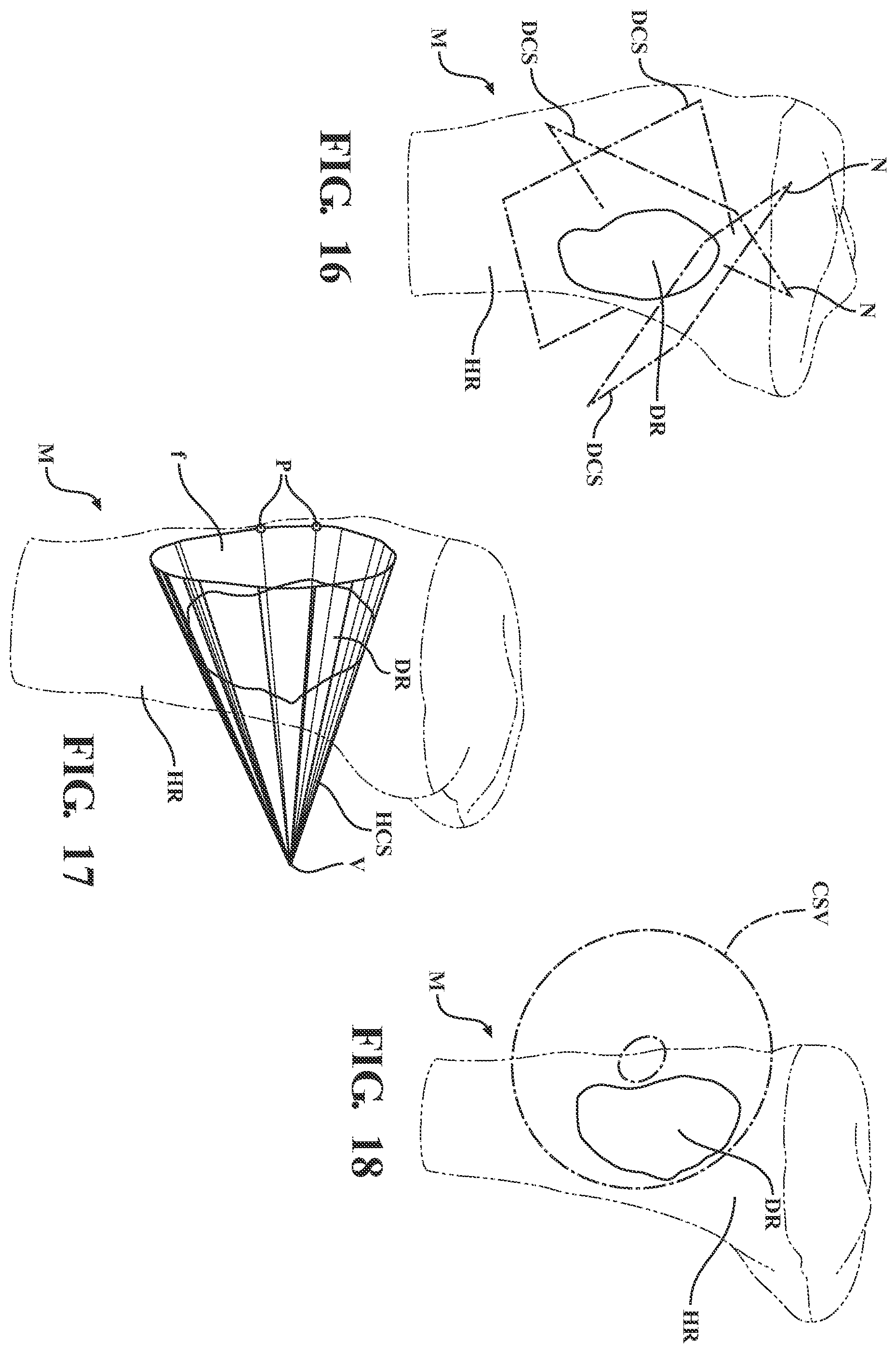 Patent US11793574 Figure 11 – Automated cut planning for removal of diseased regions