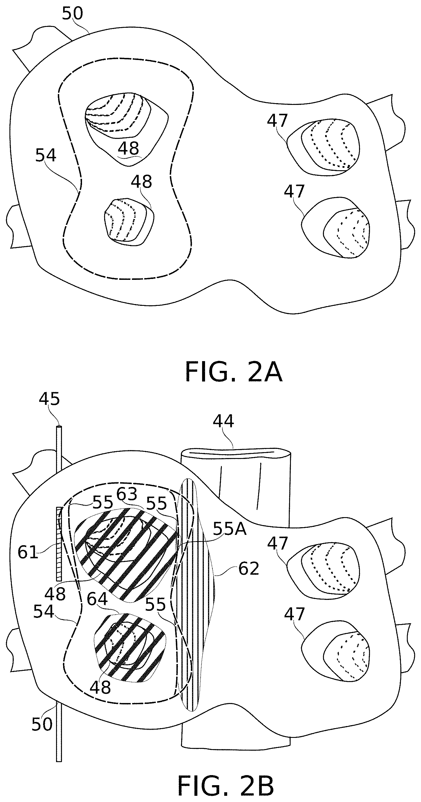 Patent US11793576 Figure 3 – Calculation of an ablation plan