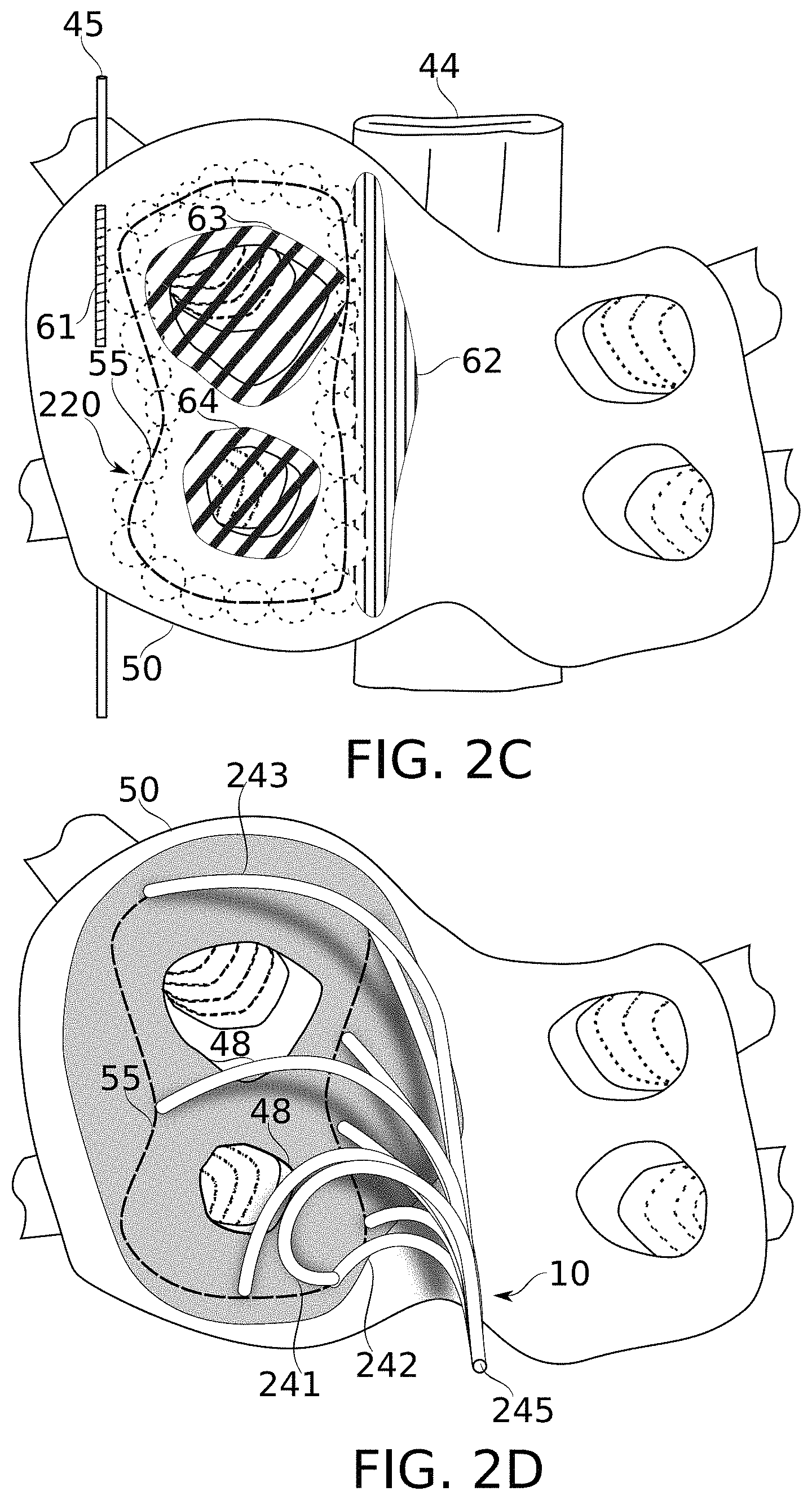 Patent US11793576 Figure 4 – Calculation of an ablation plan