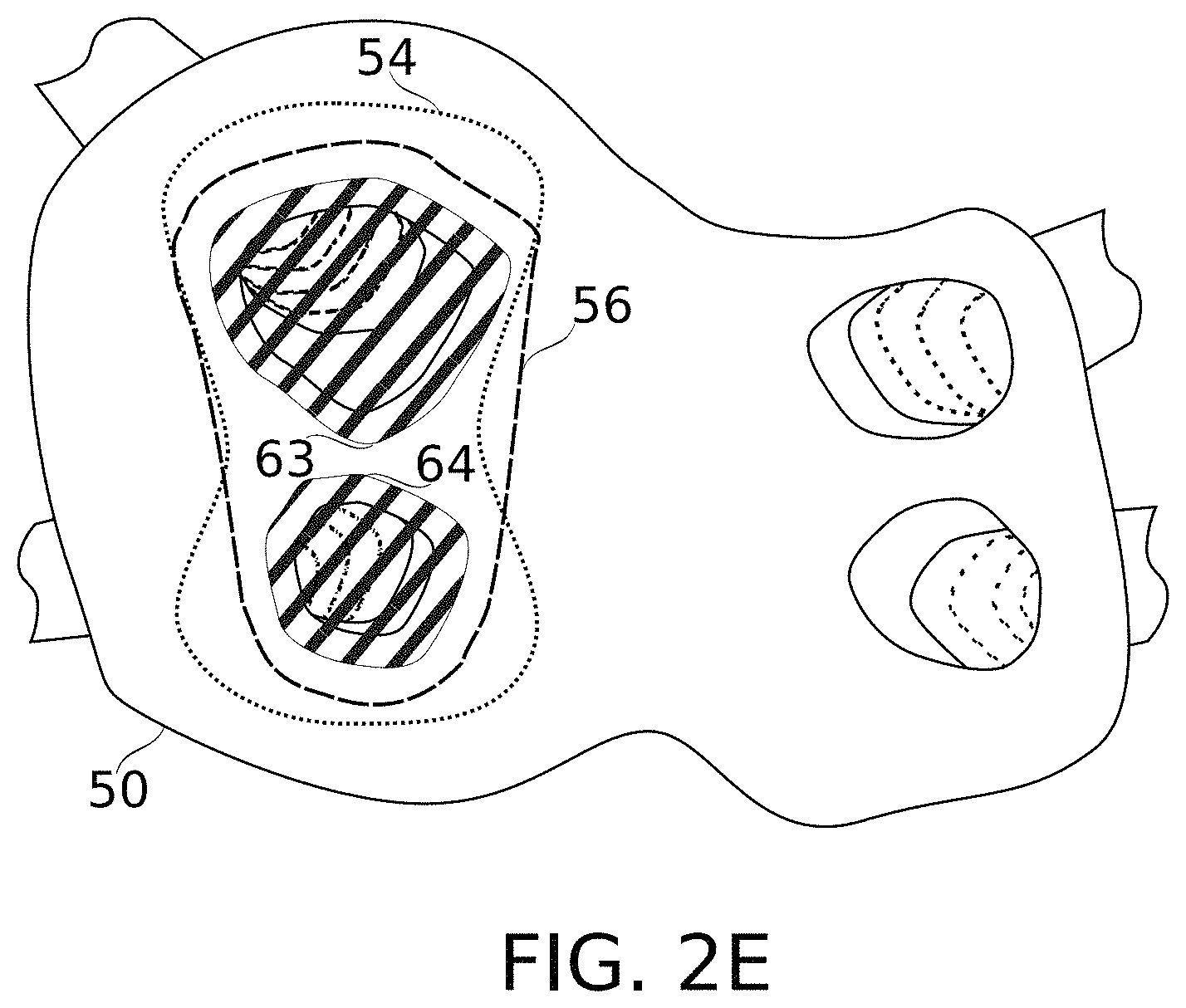 Patent US11793576 Figure 5 – Calculation of an ablation plan