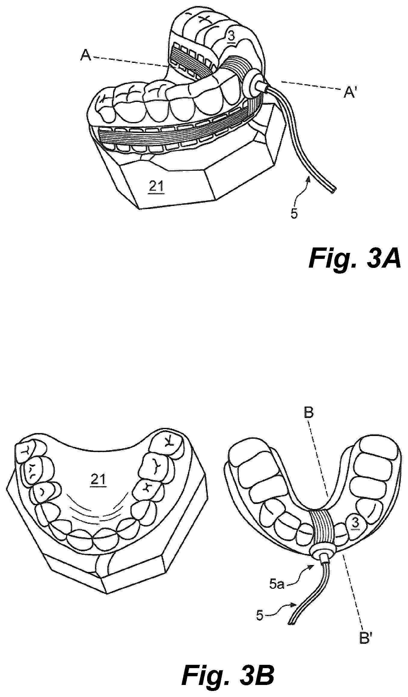 Patent US11793604 Figure 2 – Ultrasonic methods and devices for orthodontic treatment with aligners