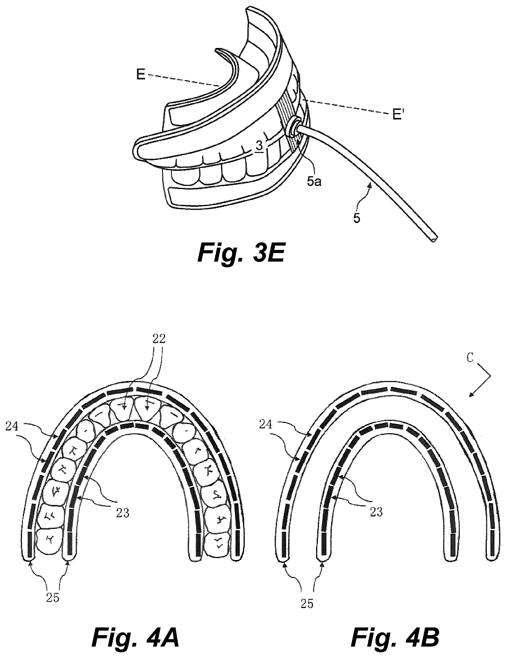 Patent US11793604 Figure 4 – Ultrasonic methods and devices for orthodontic treatment with aligners