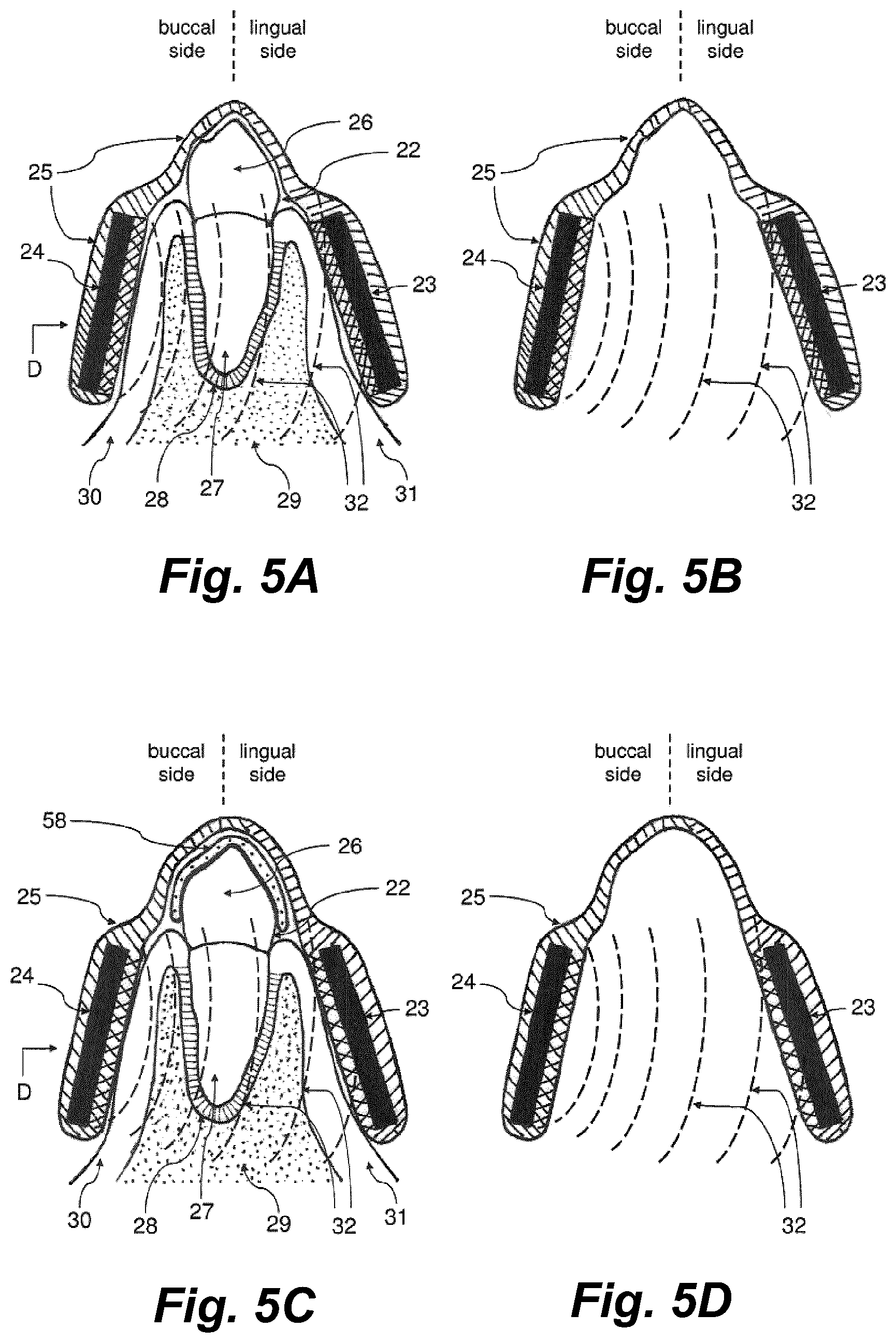 Patent US11793604 Figure 5 – Ultrasonic methods and devices for orthodontic treatment with aligners