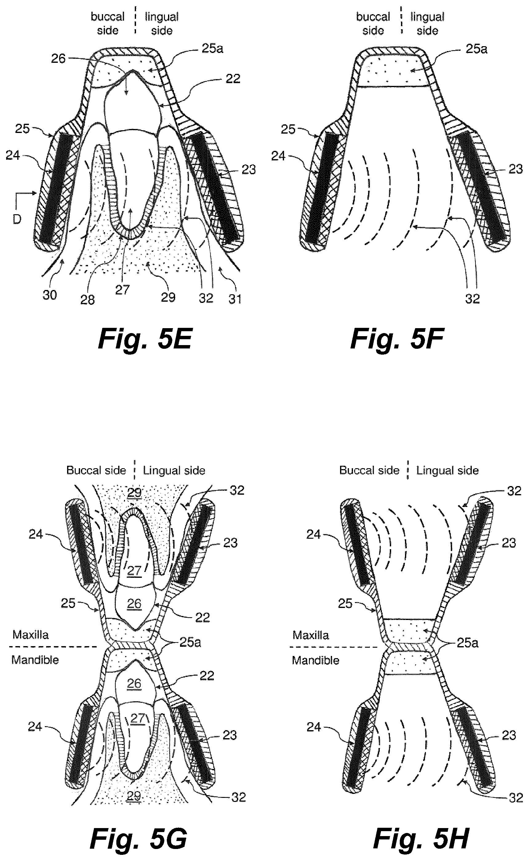 Patent US11793604 Figure 6 – Ultrasonic methods and devices for orthodontic treatment with aligners