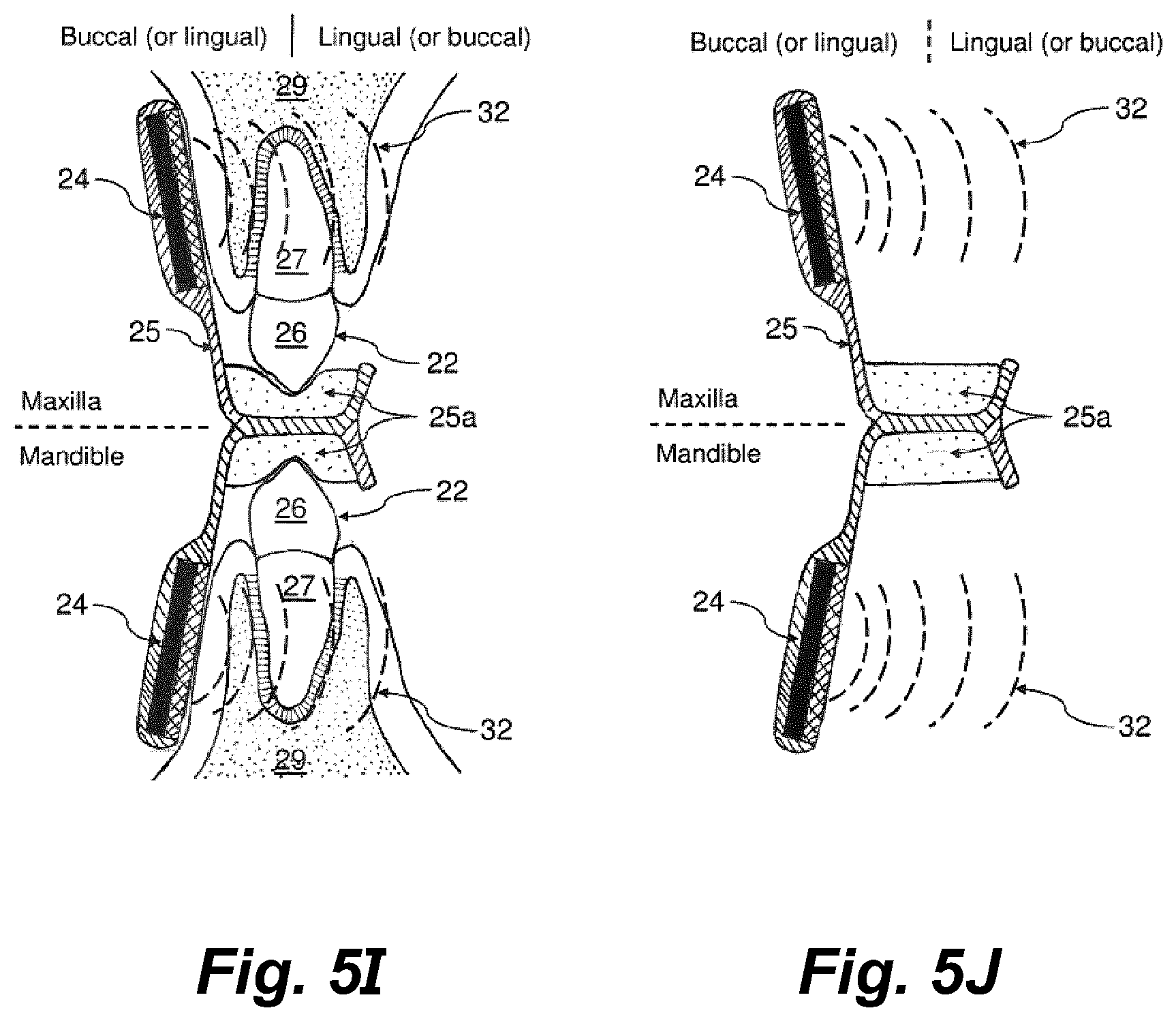 Patent US11793604 Figure 7 – Ultrasonic methods and devices for orthodontic treatment with aligners