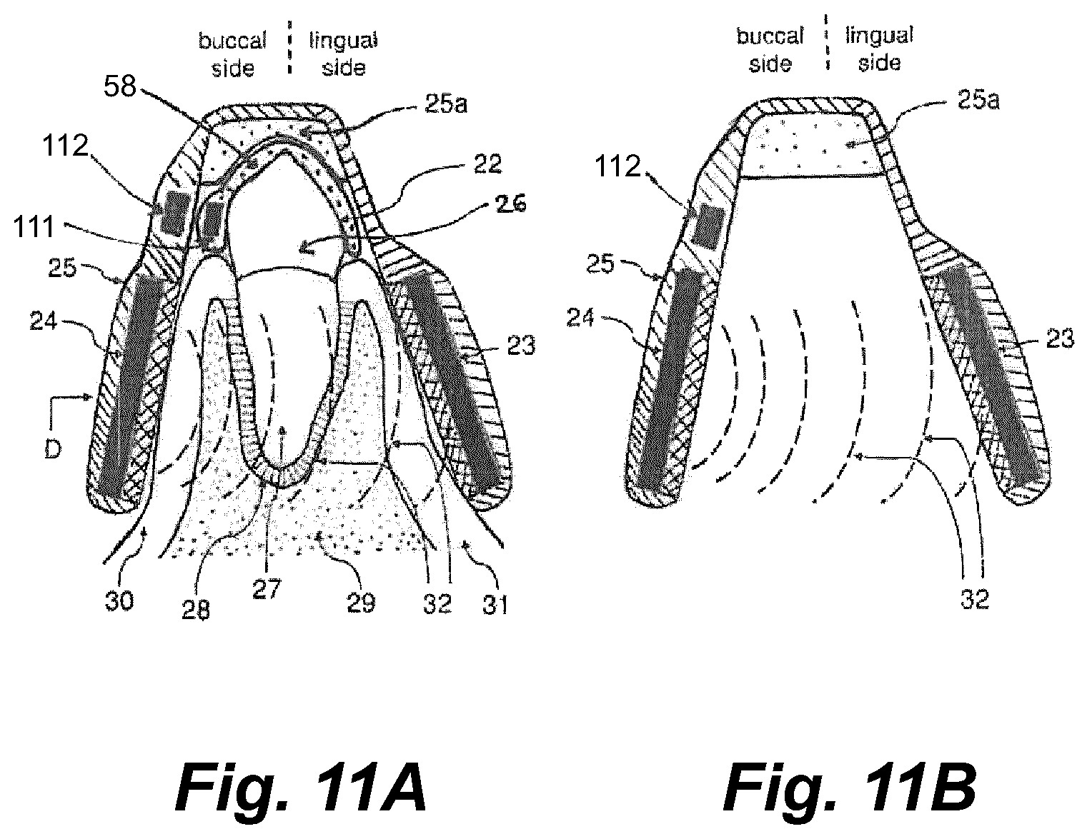 Patent US11793604 Figure 12 – Ultrasonic methods and devices for orthodontic treatment with aligners