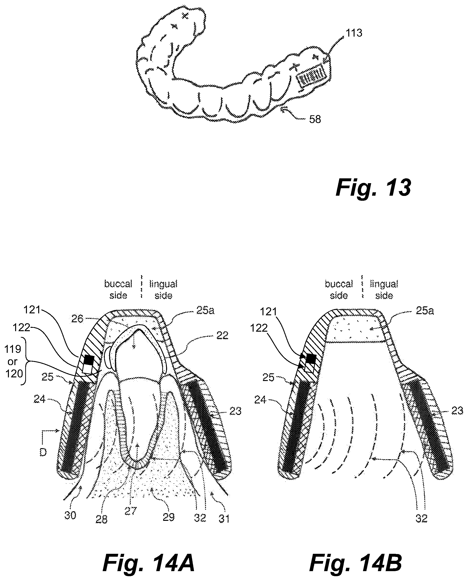 Patent US11793604 Figure 14 – Ultrasonic methods and devices for orthodontic treatment with aligners