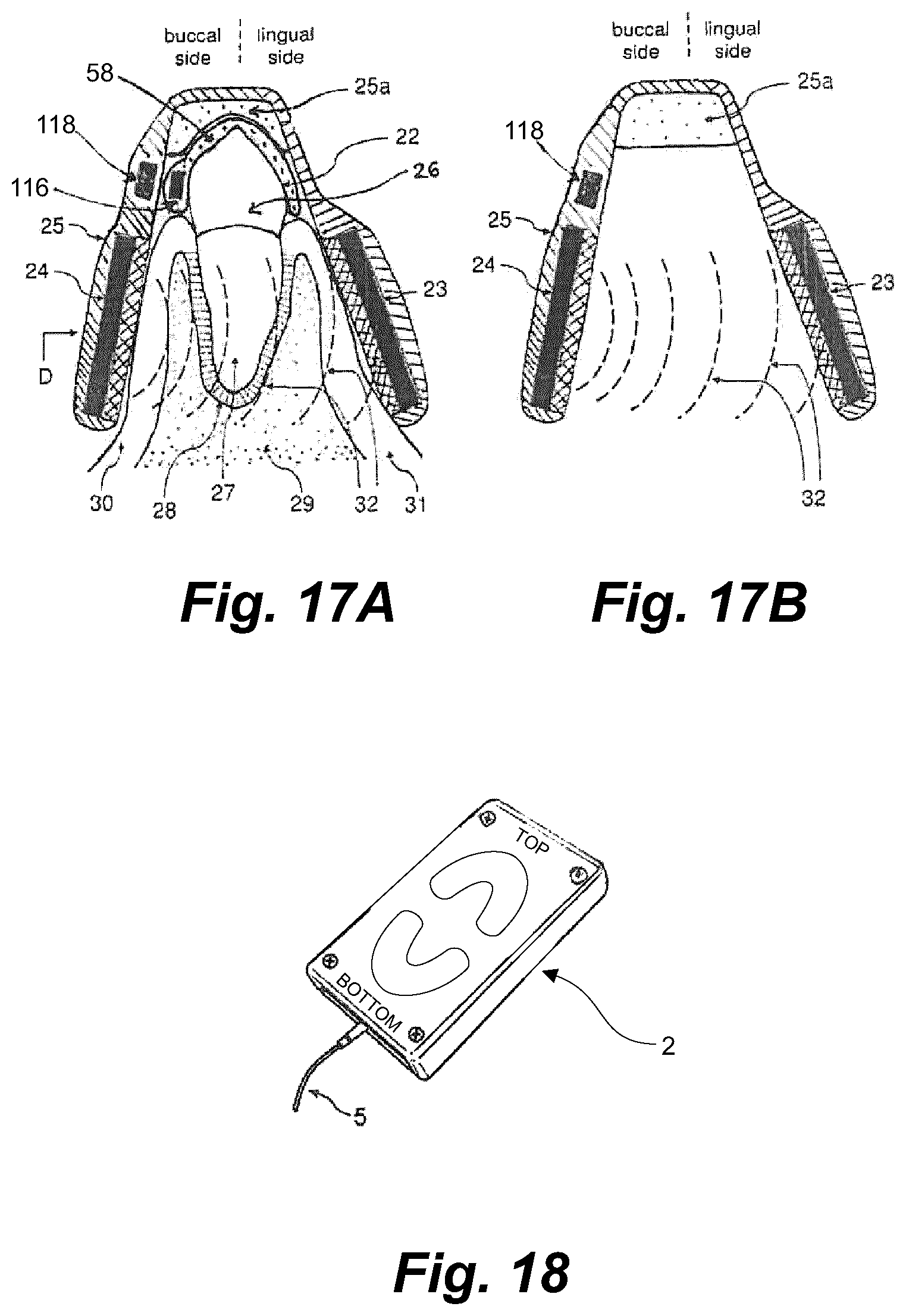 Patent US11793604 Figure 16 – Ultrasonic methods and devices for orthodontic treatment with aligners