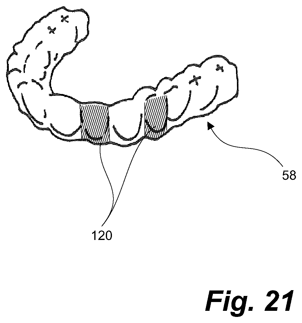 Patent US11793604 Figure 18 – Ultrasonic methods and devices for orthodontic treatment with aligners