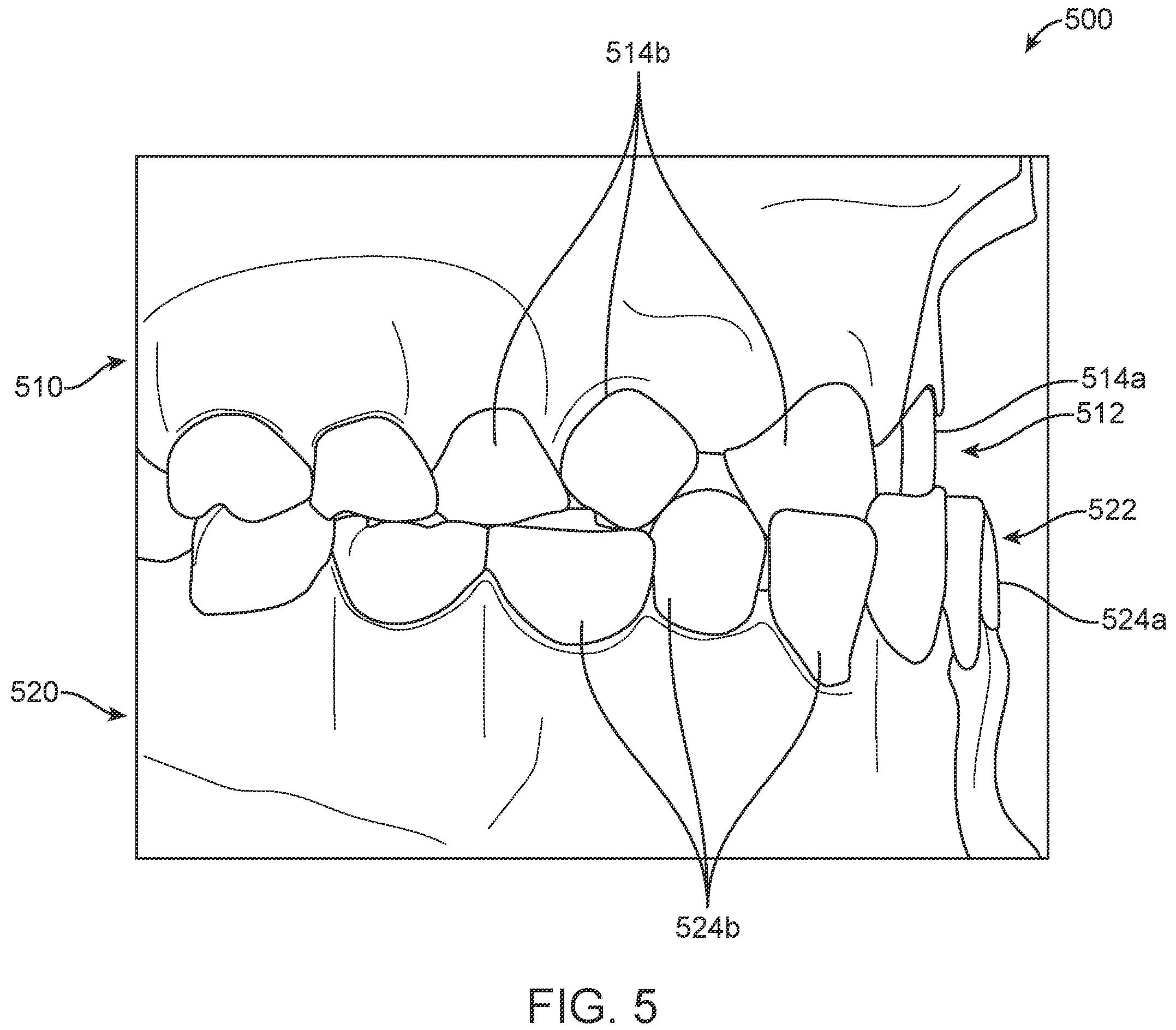 Patent US11793608 Figure 7 – Systems and methods for correcting malocclusions of teeth
