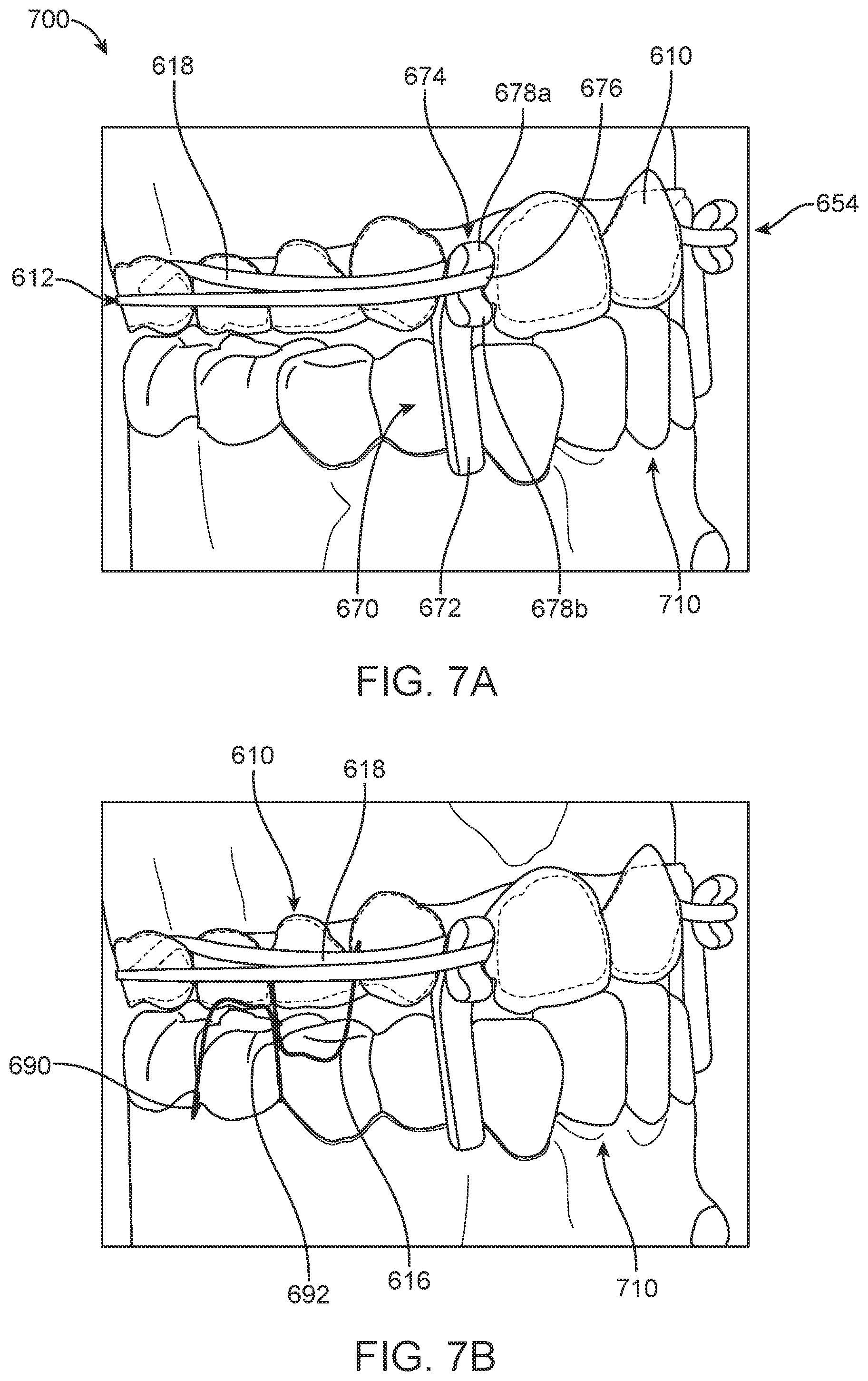 Patent US11793608 Figure 10 – Systems and methods for correcting malocclusions of teeth