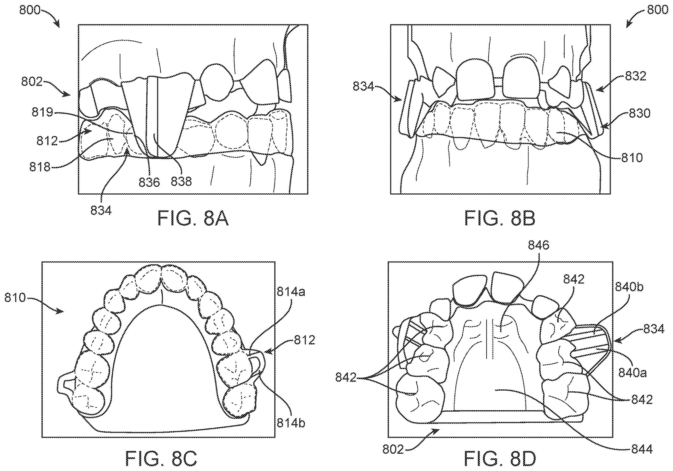 Patent US11793608 Figure 11 – Systems and methods for correcting malocclusions of teeth