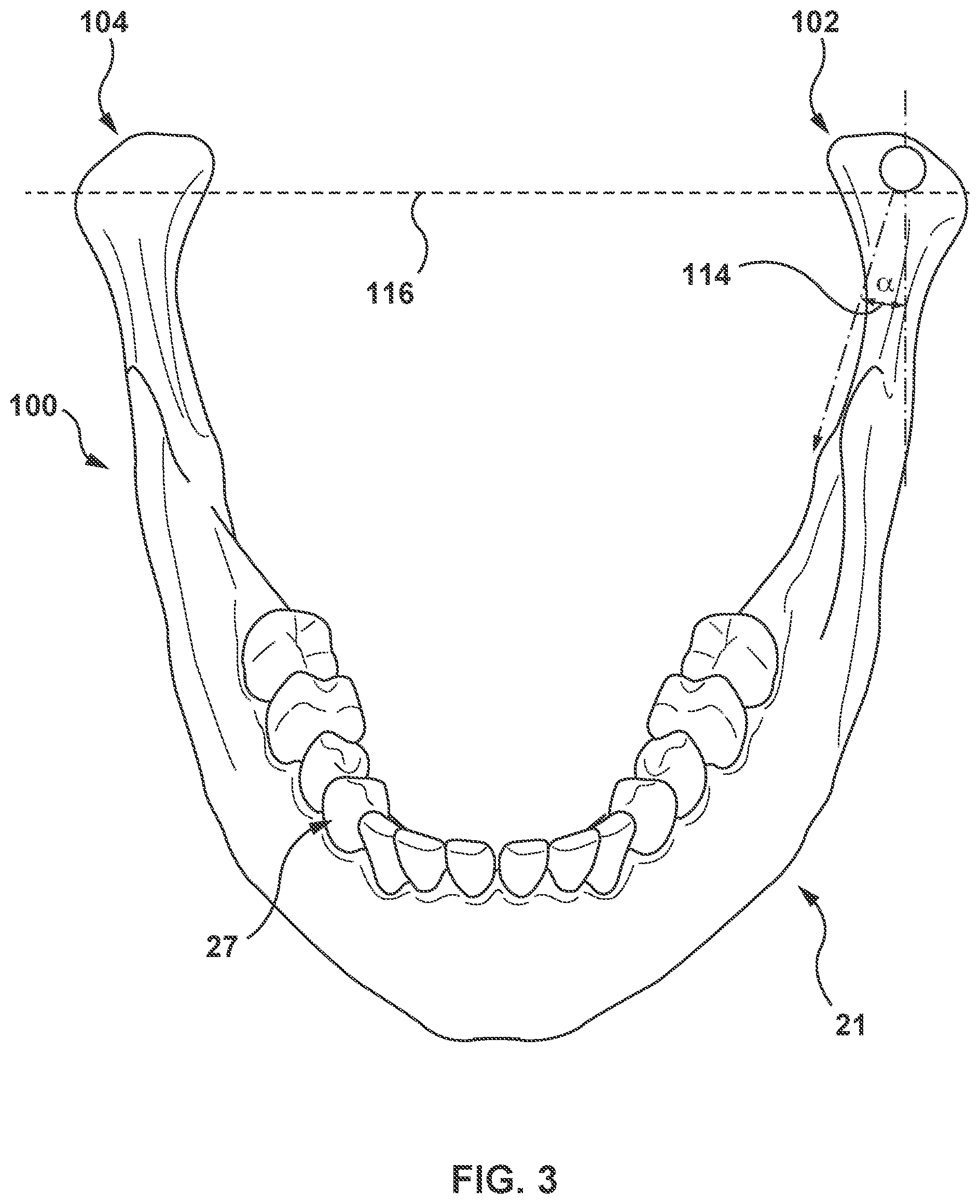Patent US11793612 Figure 3 – Methods and systems for modeling mandibular motion