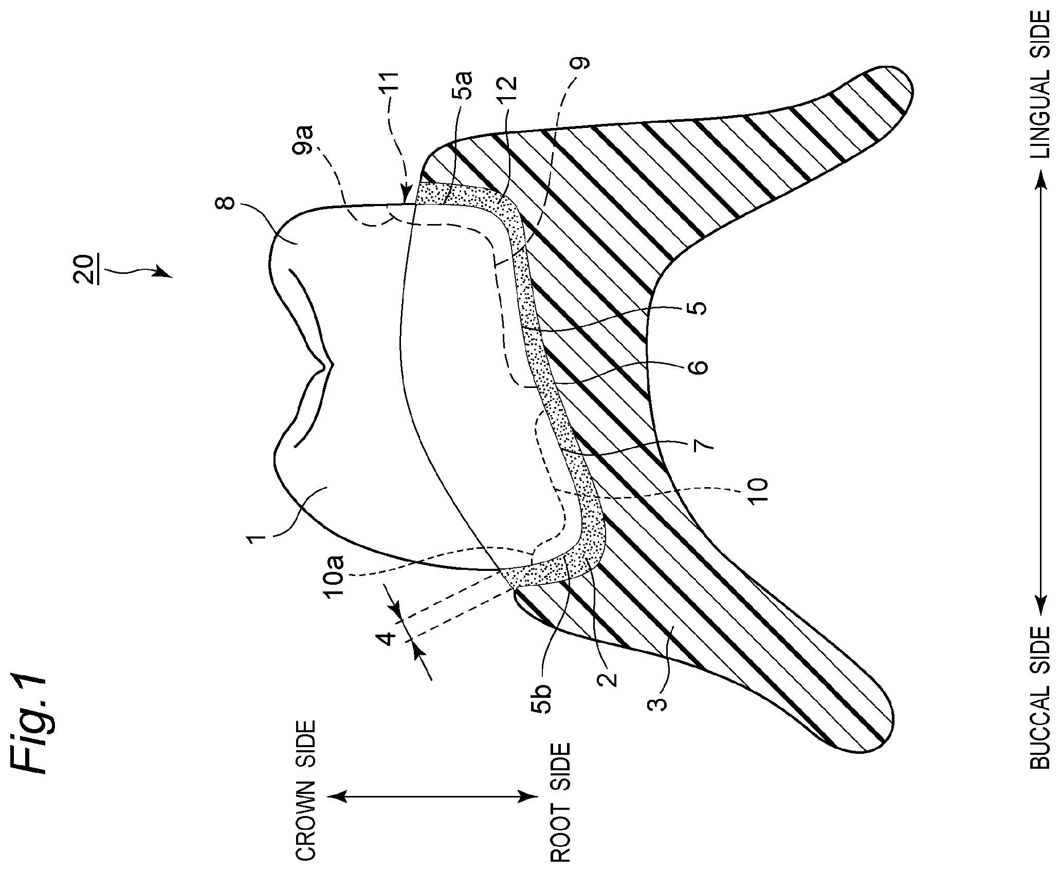 Patent US11793614 Figure 1 – Method for producing denture with high accuracy of fitting of artificial tooth to socket