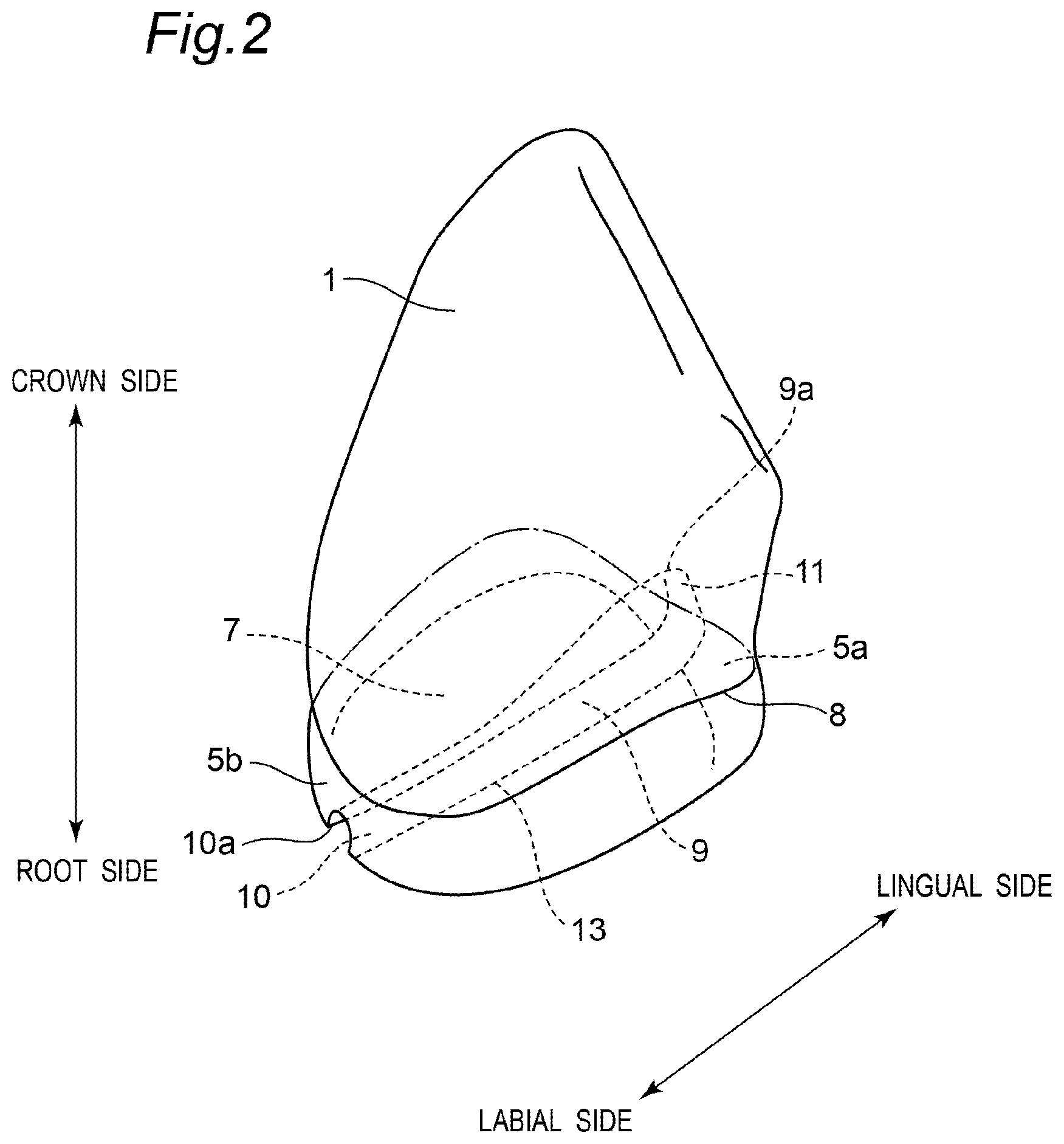 Patent US11793614 Figure 2 – Method for producing denture with high accuracy of fitting of artificial tooth to socket