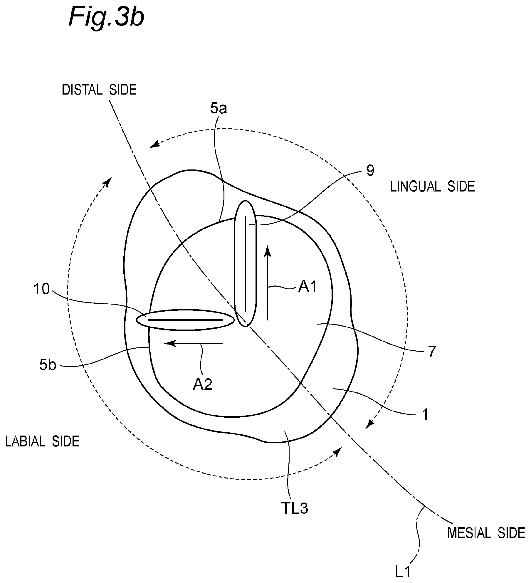 Patent US11793614 Figure 4 – Method for producing denture with high accuracy of fitting of artificial tooth to socket