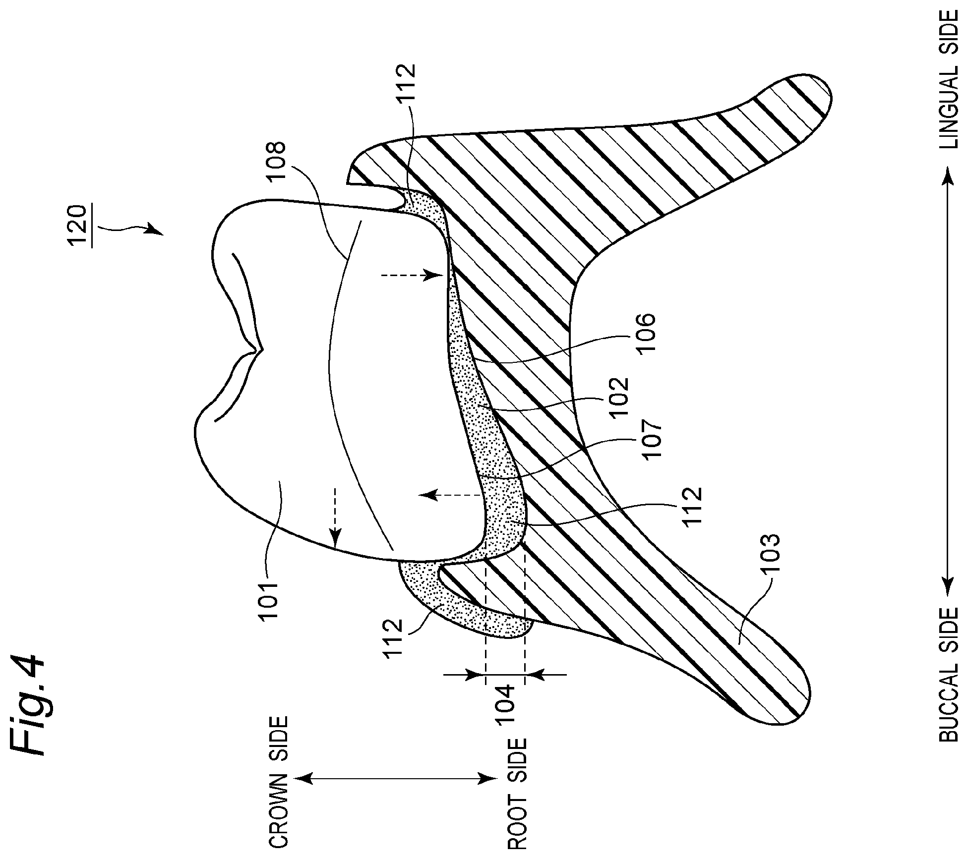 Patent US11793614 Figure 5 – Method for producing denture with high accuracy of fitting of artificial tooth to socket