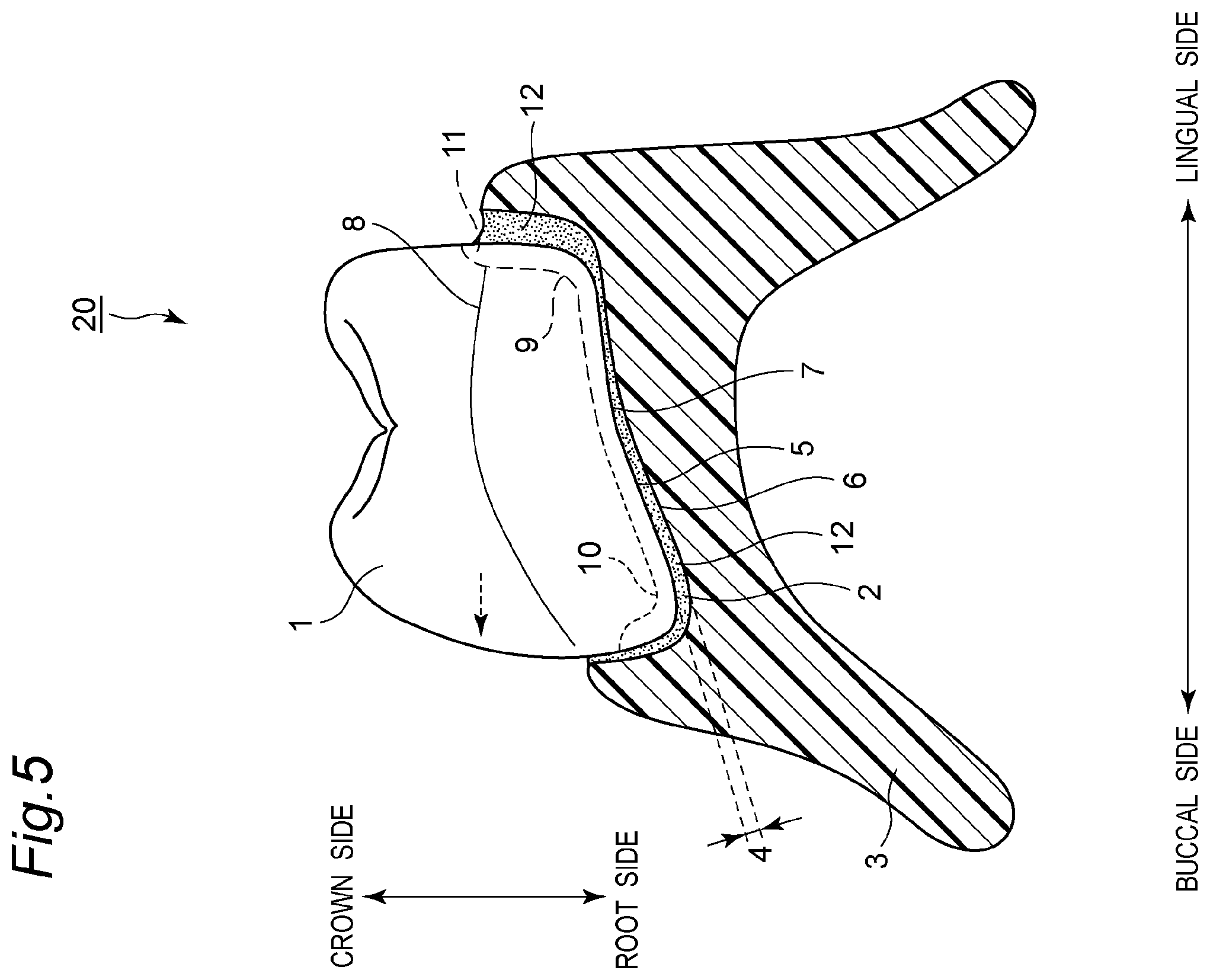 Patent US11793614 Figure 6 – Method for producing denture with high accuracy of fitting of artificial tooth to socket