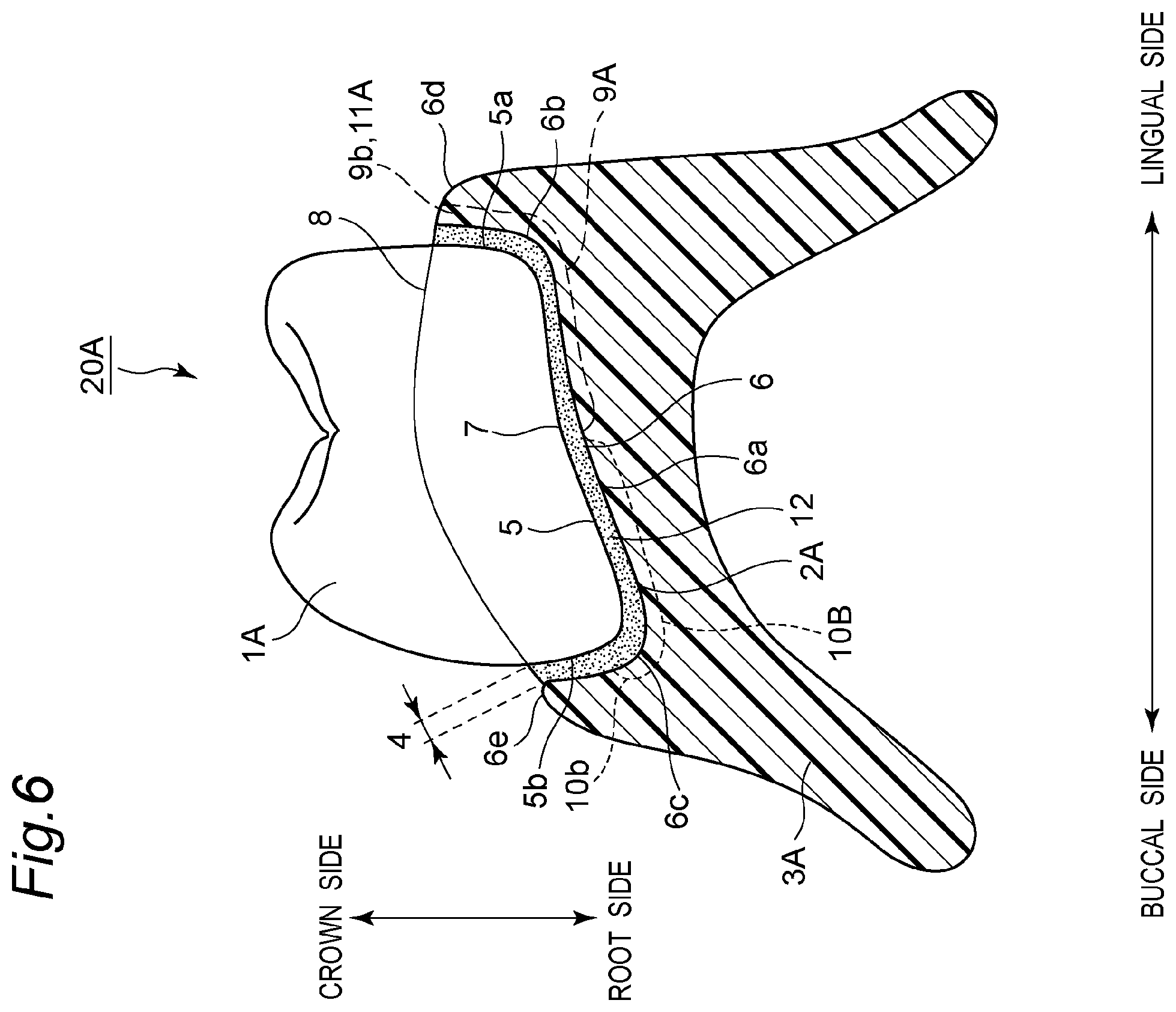 Patent US11793614 Figure 7 – Method for producing denture with high accuracy of fitting of artificial tooth to socket