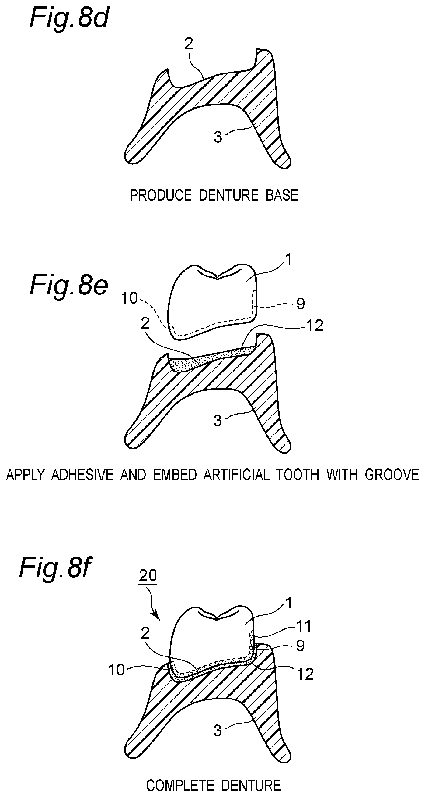 Patent US11793614 Figure 10 – Method for producing denture with high accuracy of fitting of artificial tooth to socket