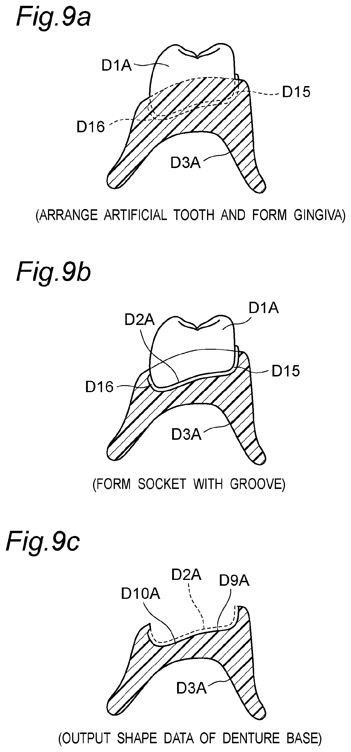 Patent US11793614 Figure 11 – Method for producing denture with high accuracy of fitting of artificial tooth to socket