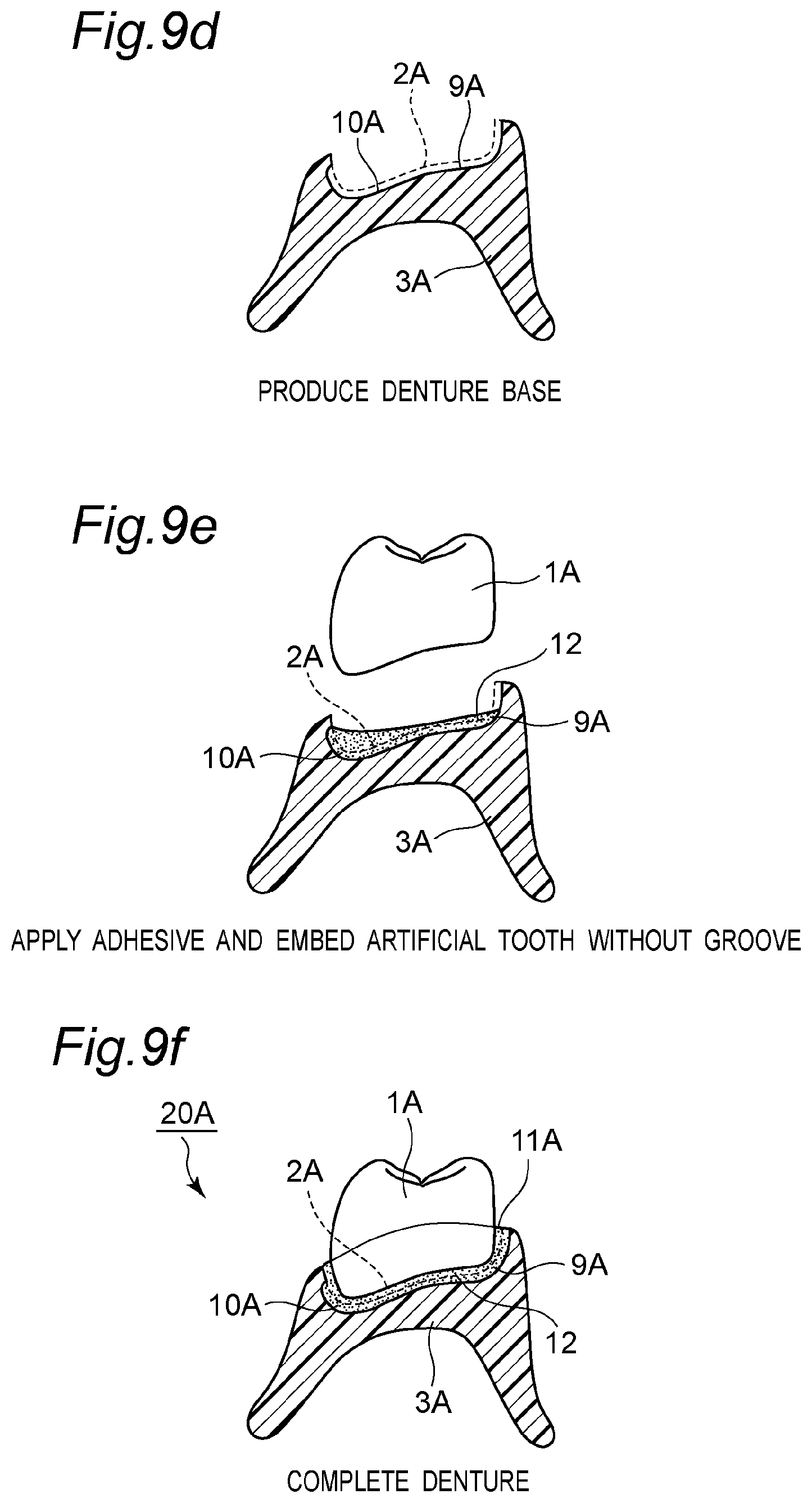Patent US11793614 Figure 12 – Method for producing denture with high accuracy of fitting of artificial tooth to socket