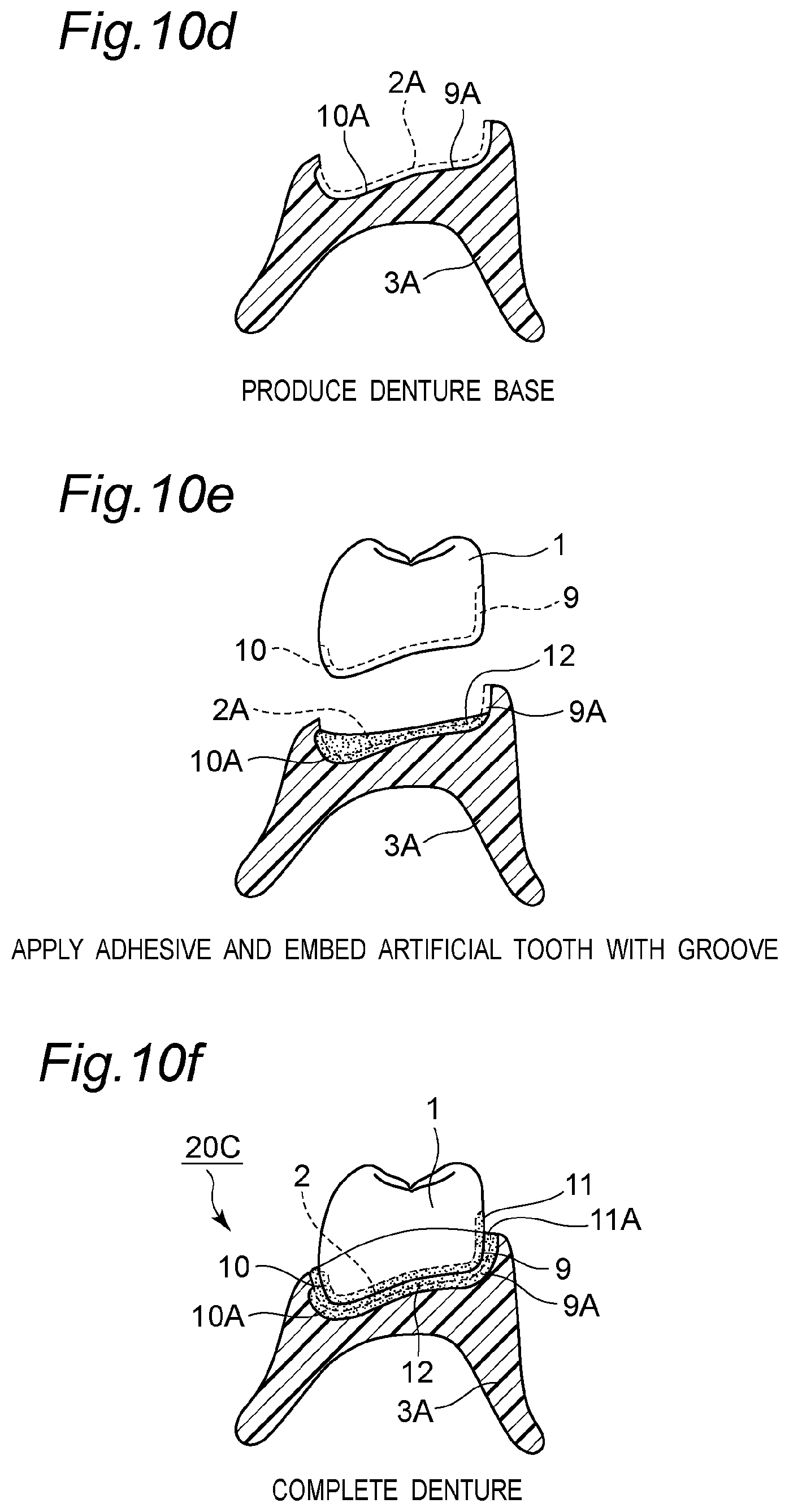 Patent US11793614 Figure 14 – Method for producing denture with high accuracy of fitting of artificial tooth to socket