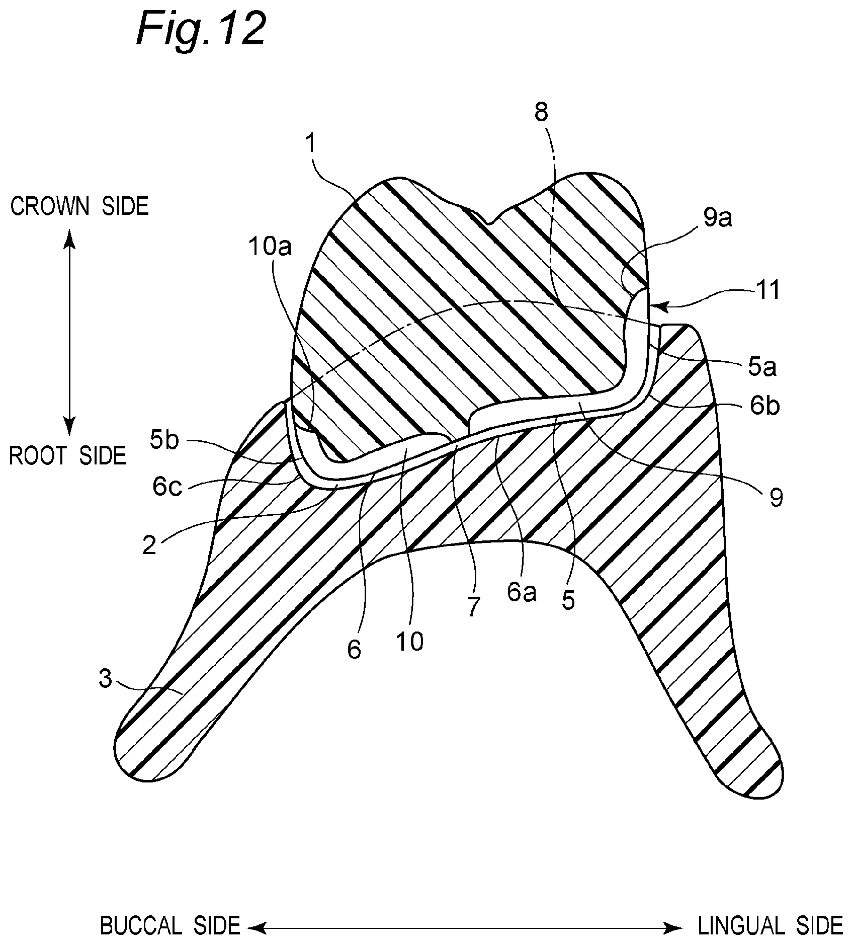 Patent US11793614 Figure 16 – Method for producing denture with high accuracy of fitting of artificial tooth to socket