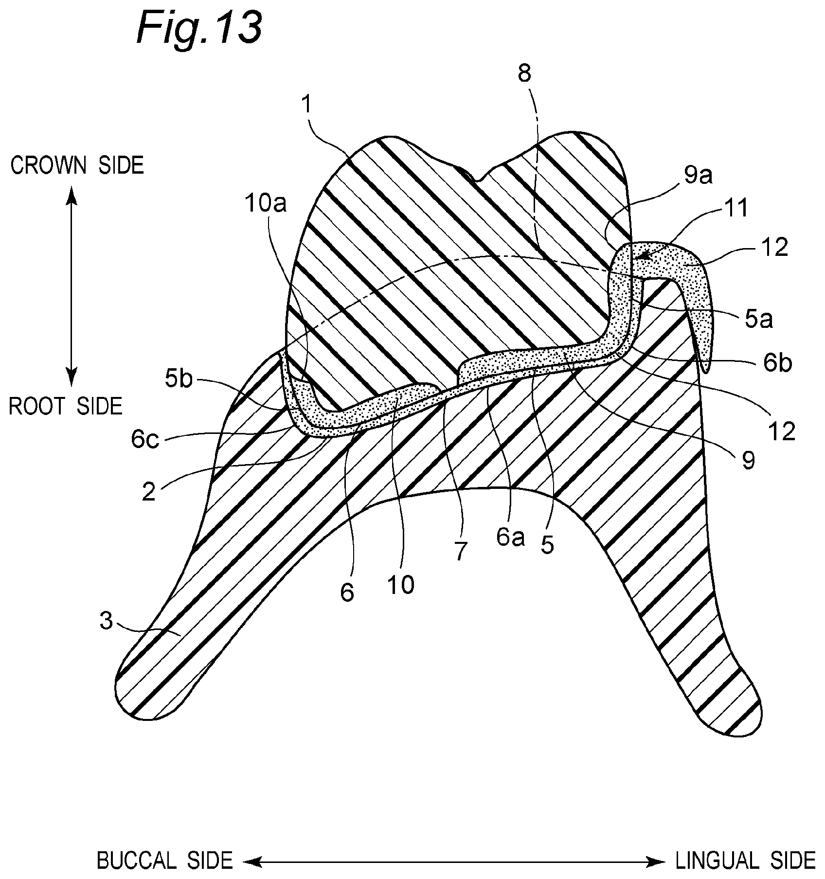Patent US11793614 Figure 17 – Method for producing denture with high accuracy of fitting of artificial tooth to socket