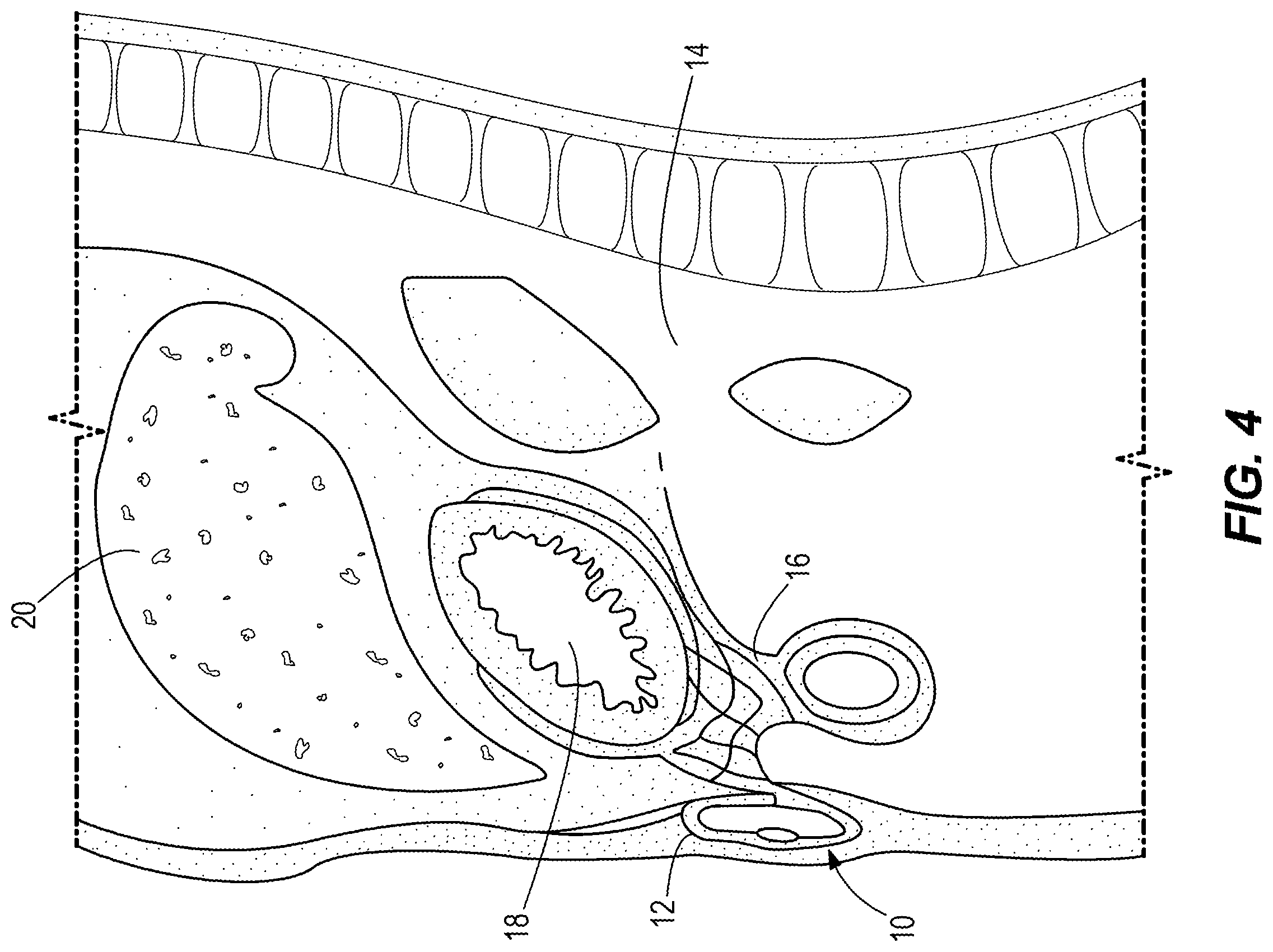 Patent US11793622 Figure 3 – Artificial interstitium device