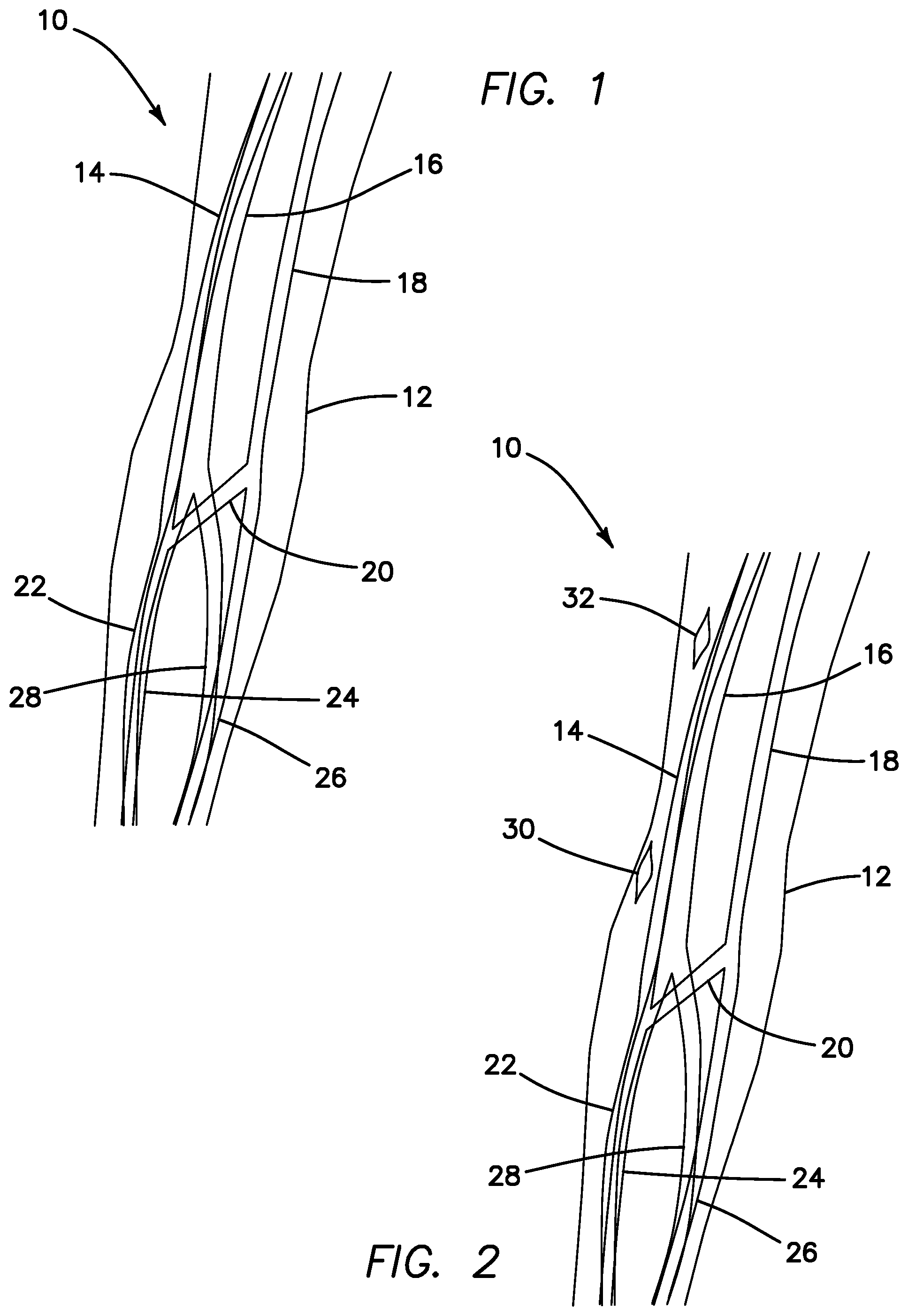 Patent US11793623 — Systems and methods for percutaneously placing biologic grafts at a procedural site — Figure 1