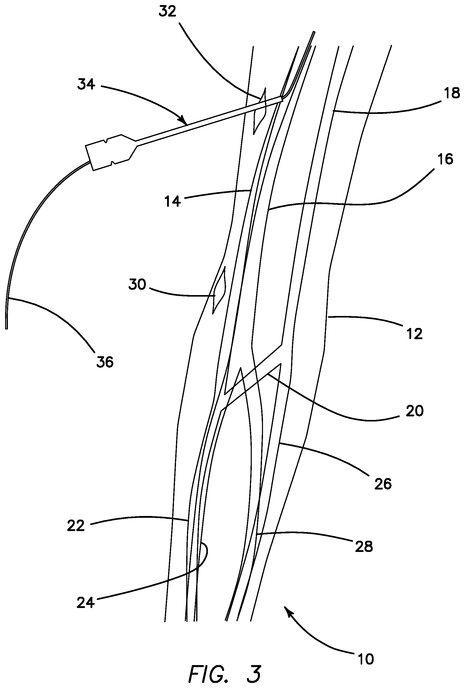 Patent US11793623 Figure 2 – Systems and methods for percutaneously placing biologic grafts at a procedural site