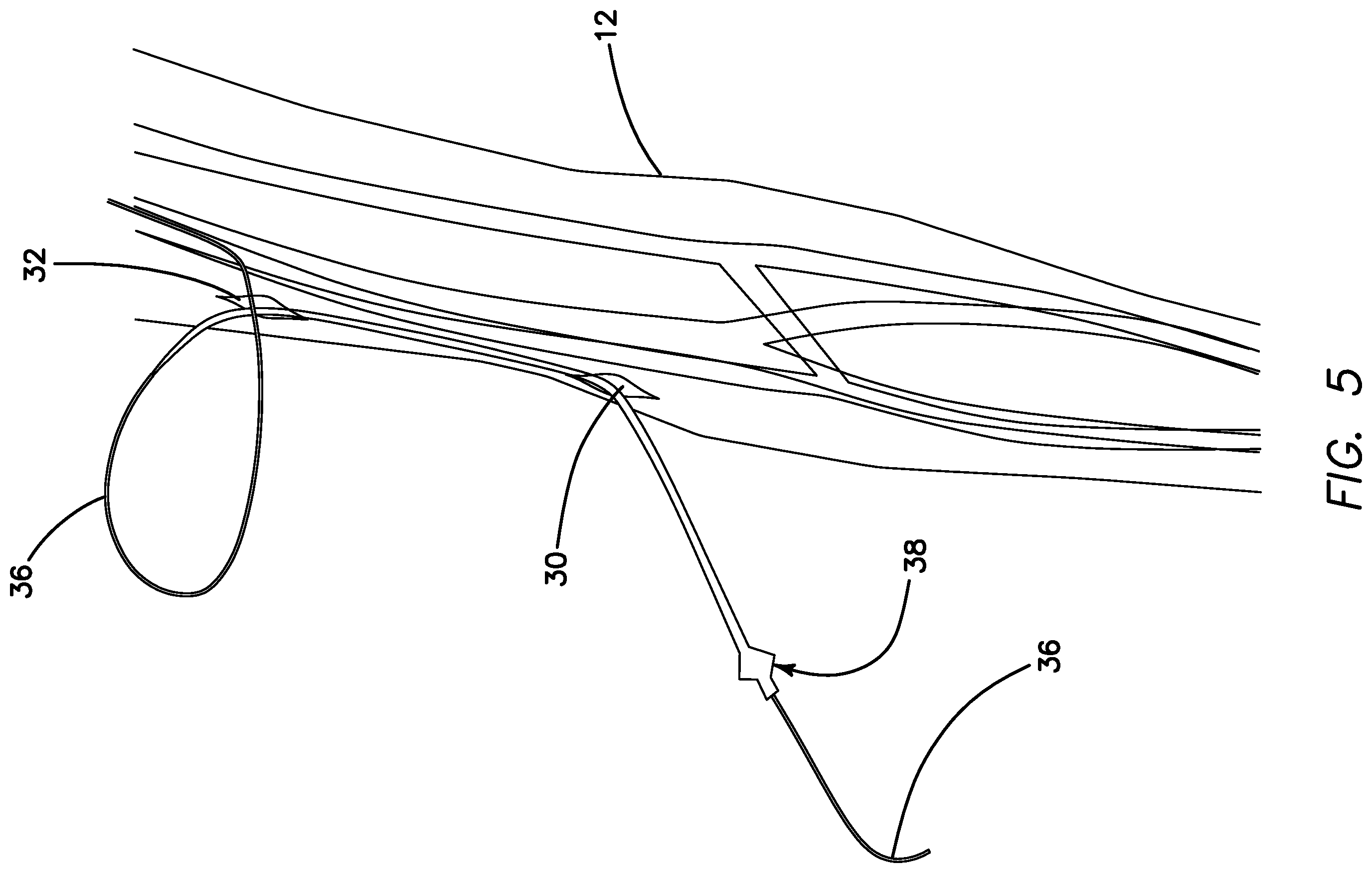 Patent US11793623 Figure 4 – Systems and methods for percutaneously placing biologic grafts at a procedural site