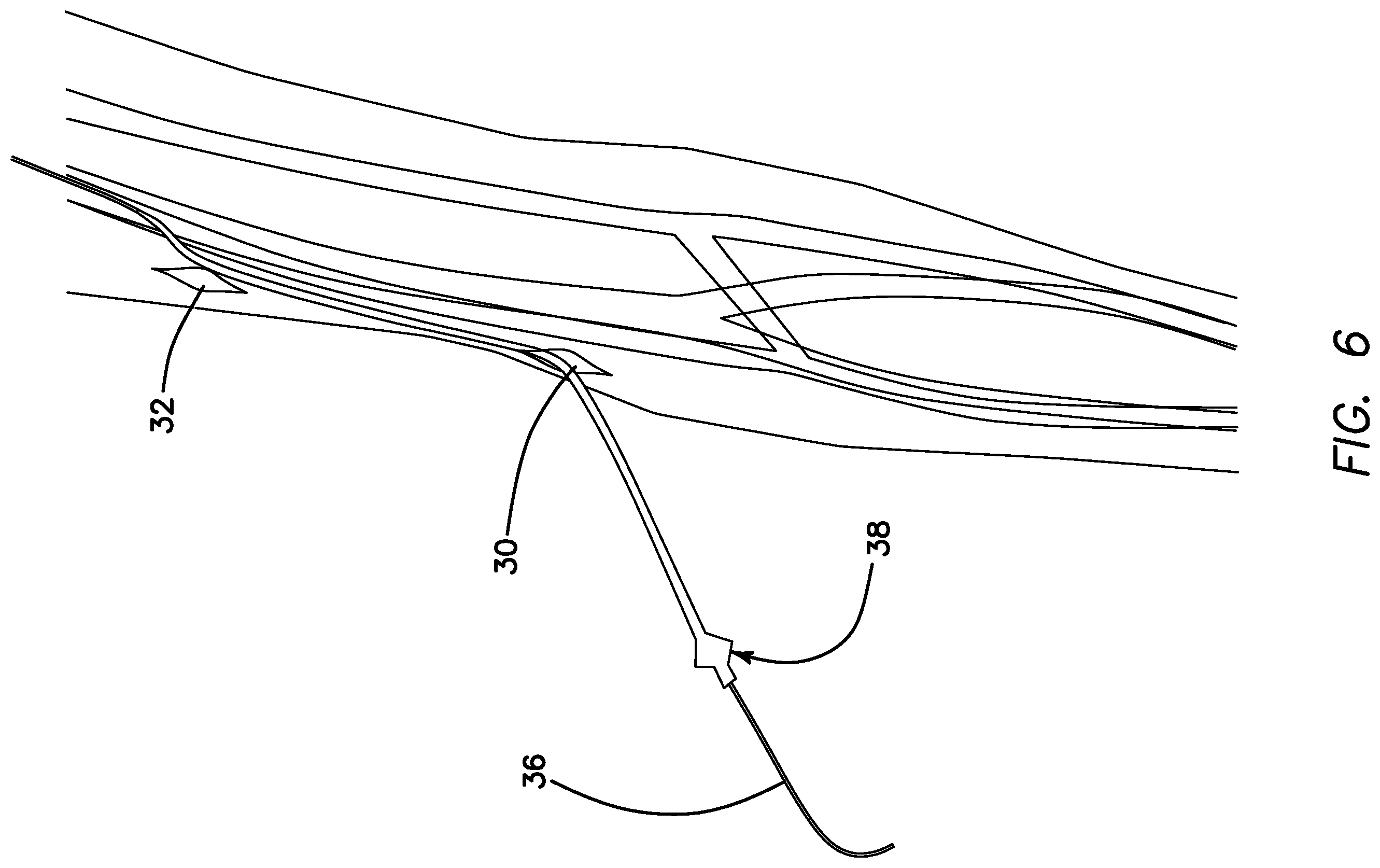 Patent US11793623 Figure 5 – Systems and methods for percutaneously placing biologic grafts at a procedural site