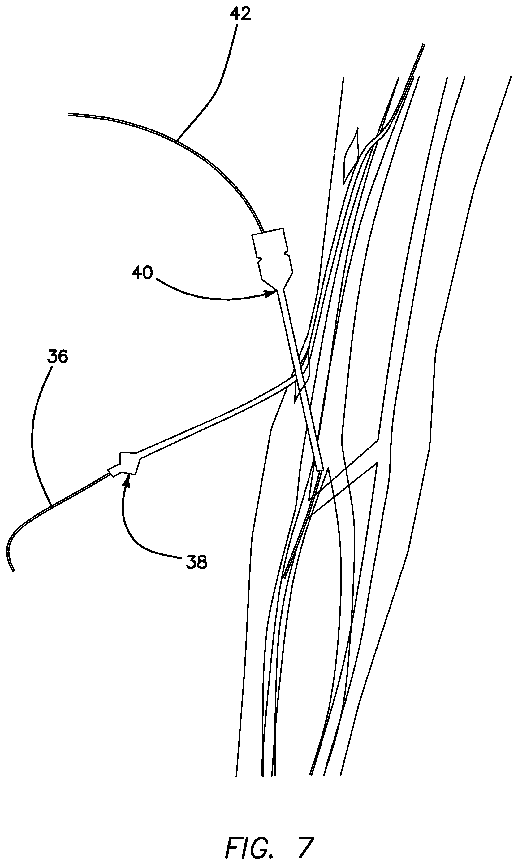 Patent US11793623 Figure 6 – Systems and methods for percutaneously placing biologic grafts at a procedural site