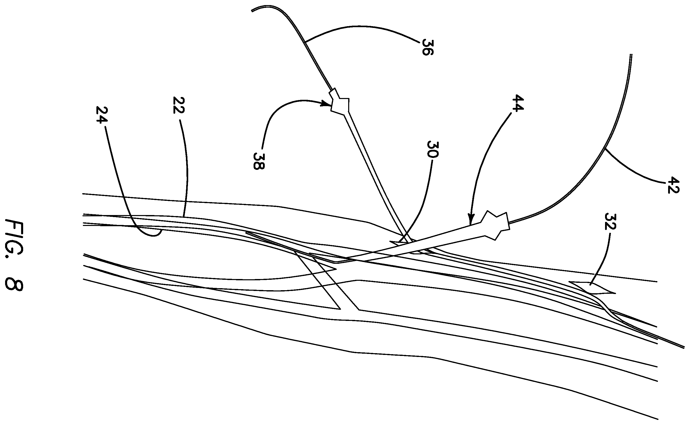Patent US11793623 Figure 7 – Systems and methods for percutaneously placing biologic grafts at a procedural site