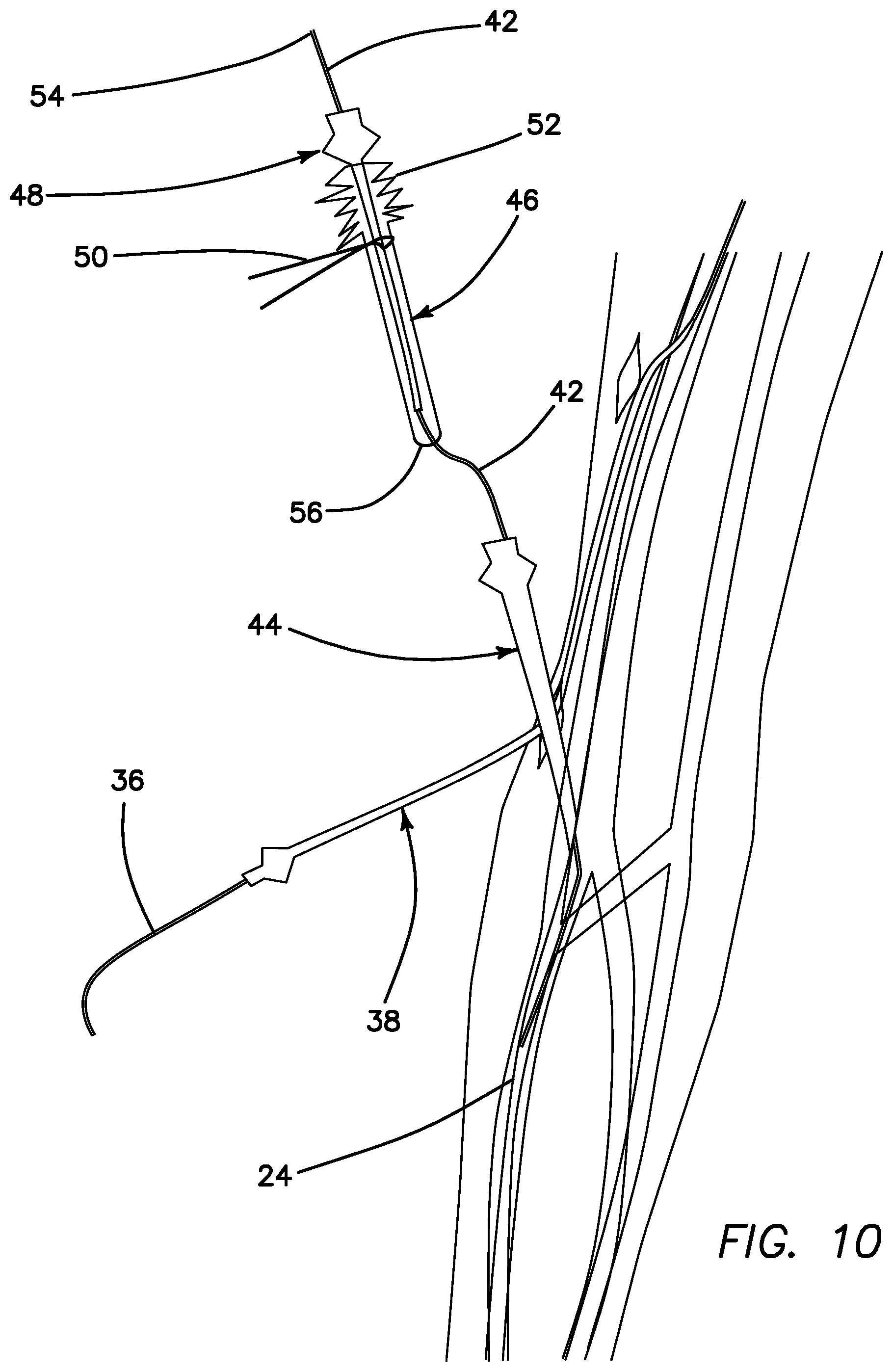 Patent US11793623 Figure 9 – Systems and methods for percutaneously placing biologic grafts at a procedural site