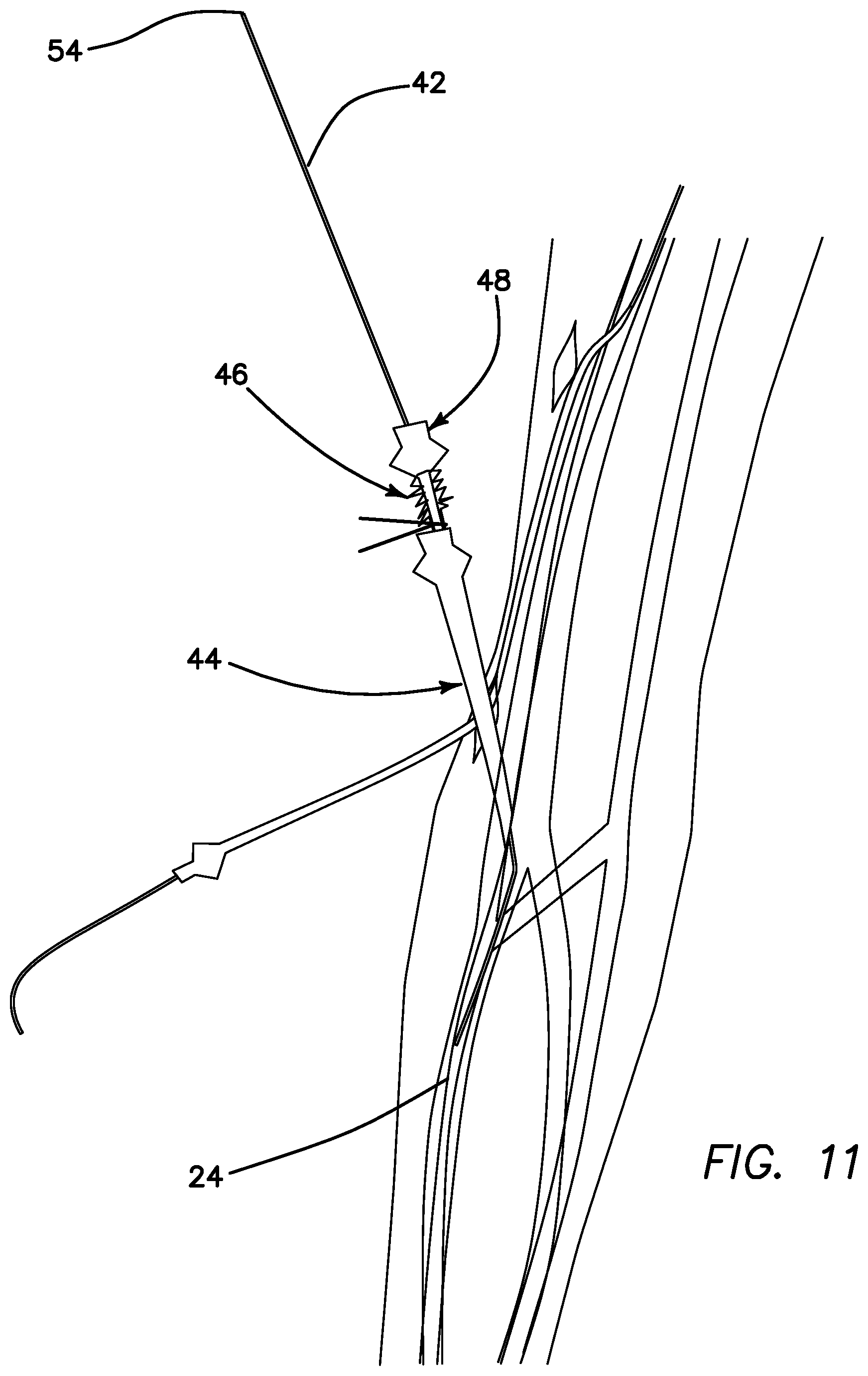 Patent US11793623 Figure 10 – Systems and methods for percutaneously placing biologic grafts at a procedural site