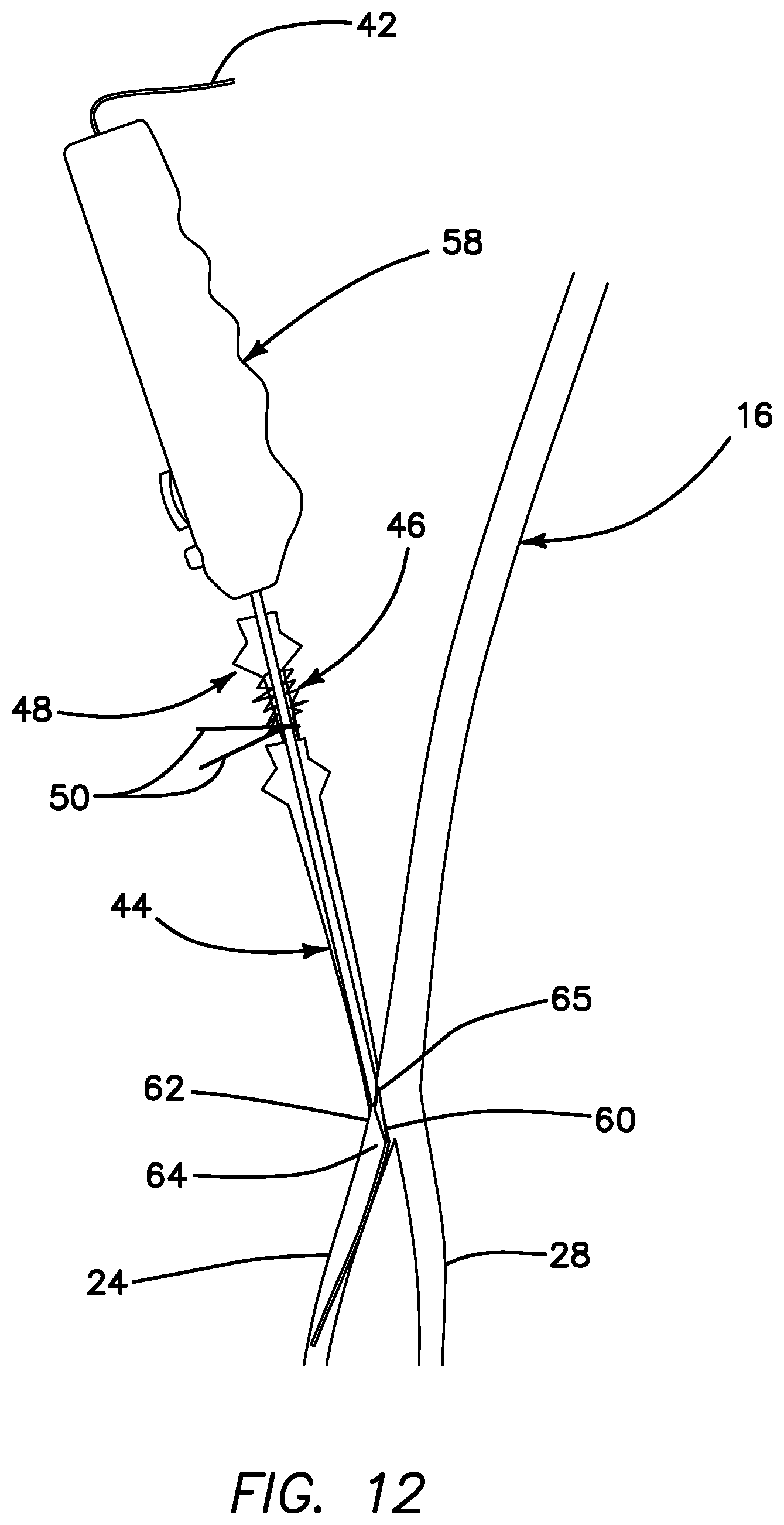Patent US11793623 Figure 11 – Systems and methods for percutaneously placing biologic grafts at a procedural site