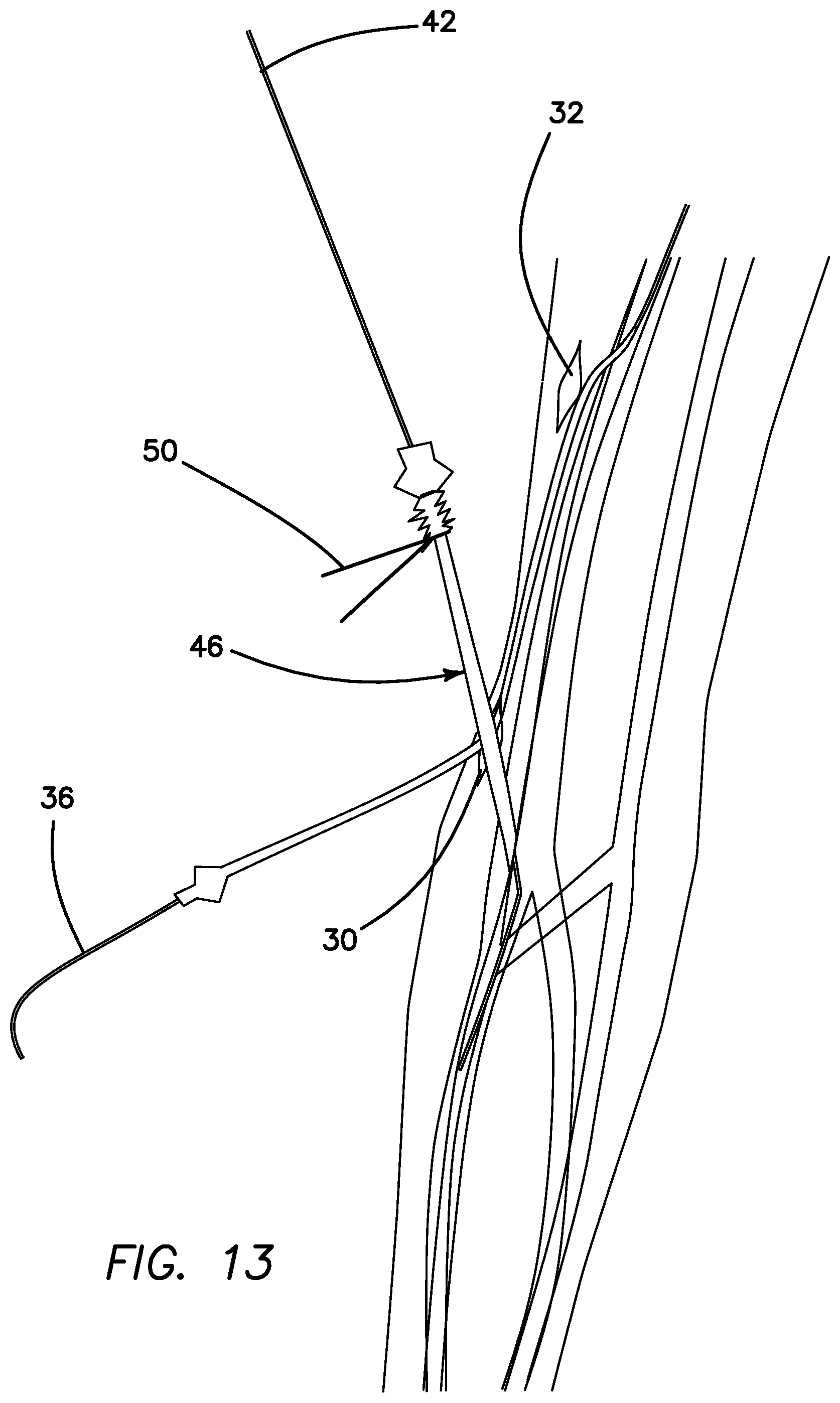 Patent US11793623 Figure 12 – Systems and methods for percutaneously placing biologic grafts at a procedural site